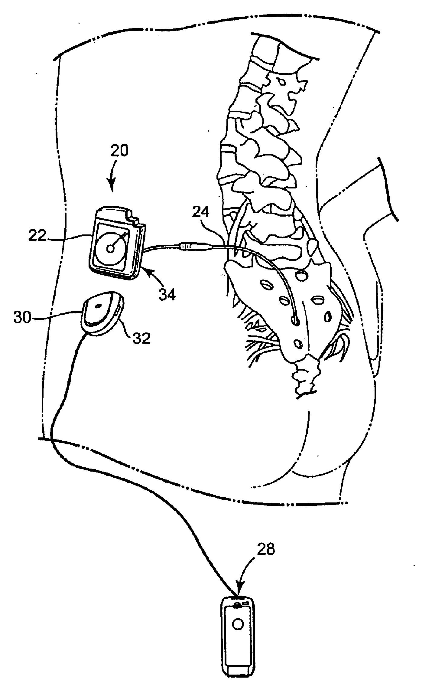 Accessory apparatus for improved recharging of implantable medical device