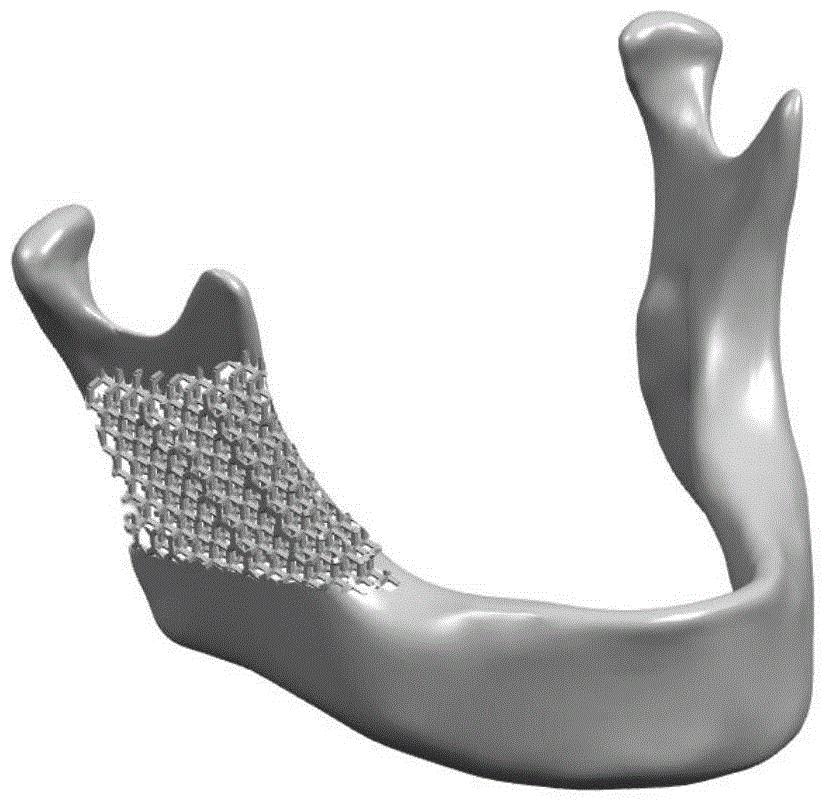 A rod system pore structure and its orthopedic implant