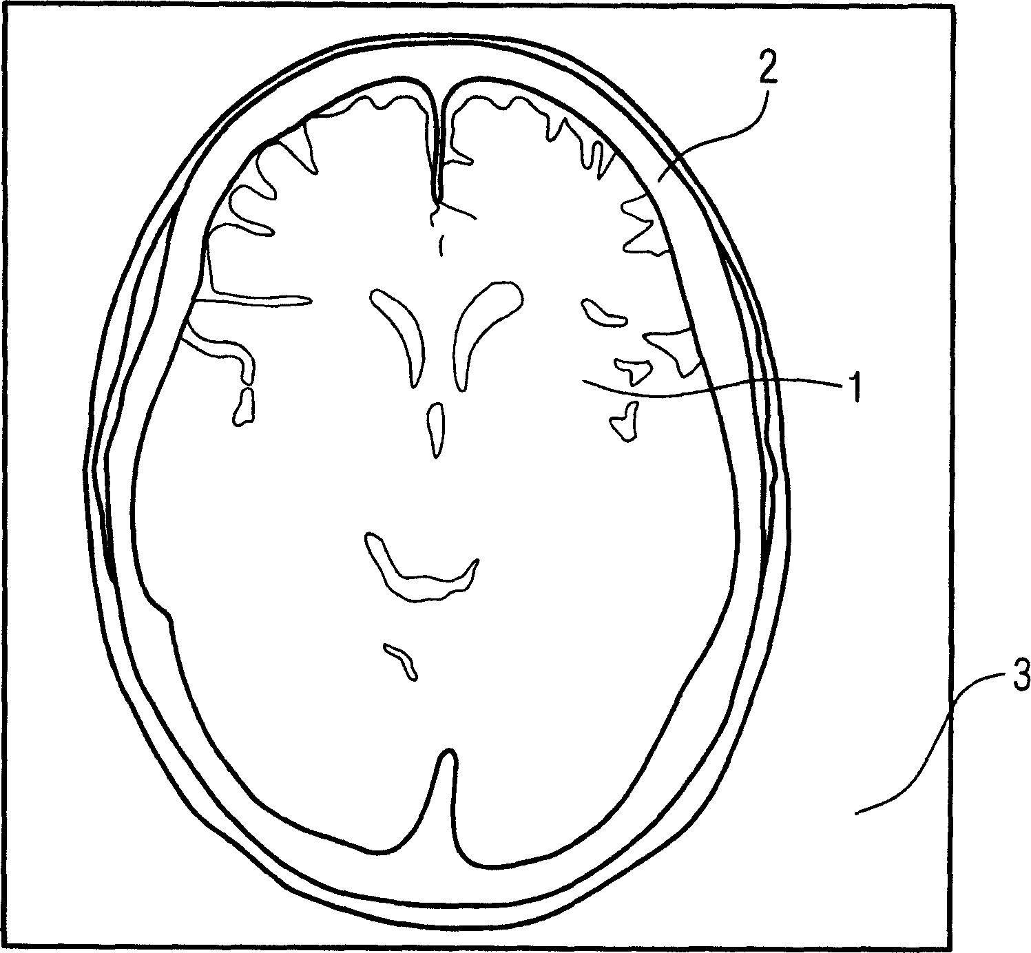 Method and device for improving the representation of ct recordings