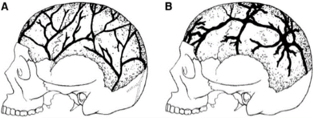 Parametric design method of defective skull tissue engineering vascular stent on the basis of microscope CT (Computed Tomography) measurement