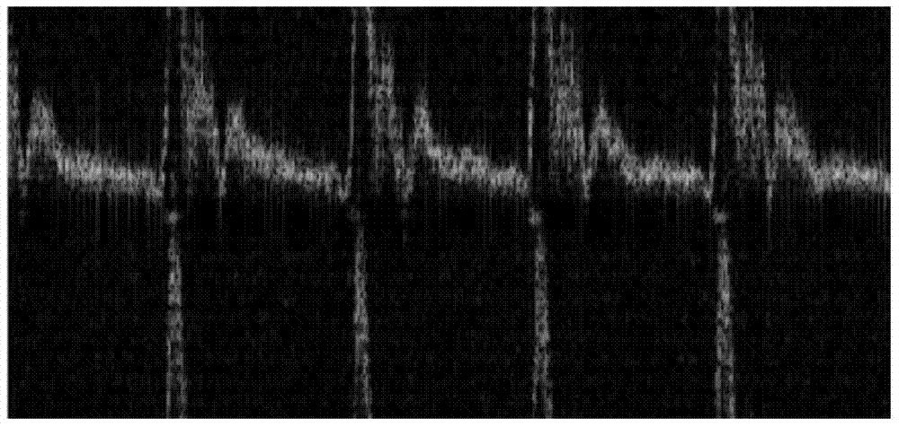 Ultrasonic system Doppler signal gap interpolation method and system