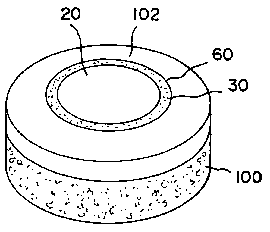 Cartilage implant assembly and method for implantation