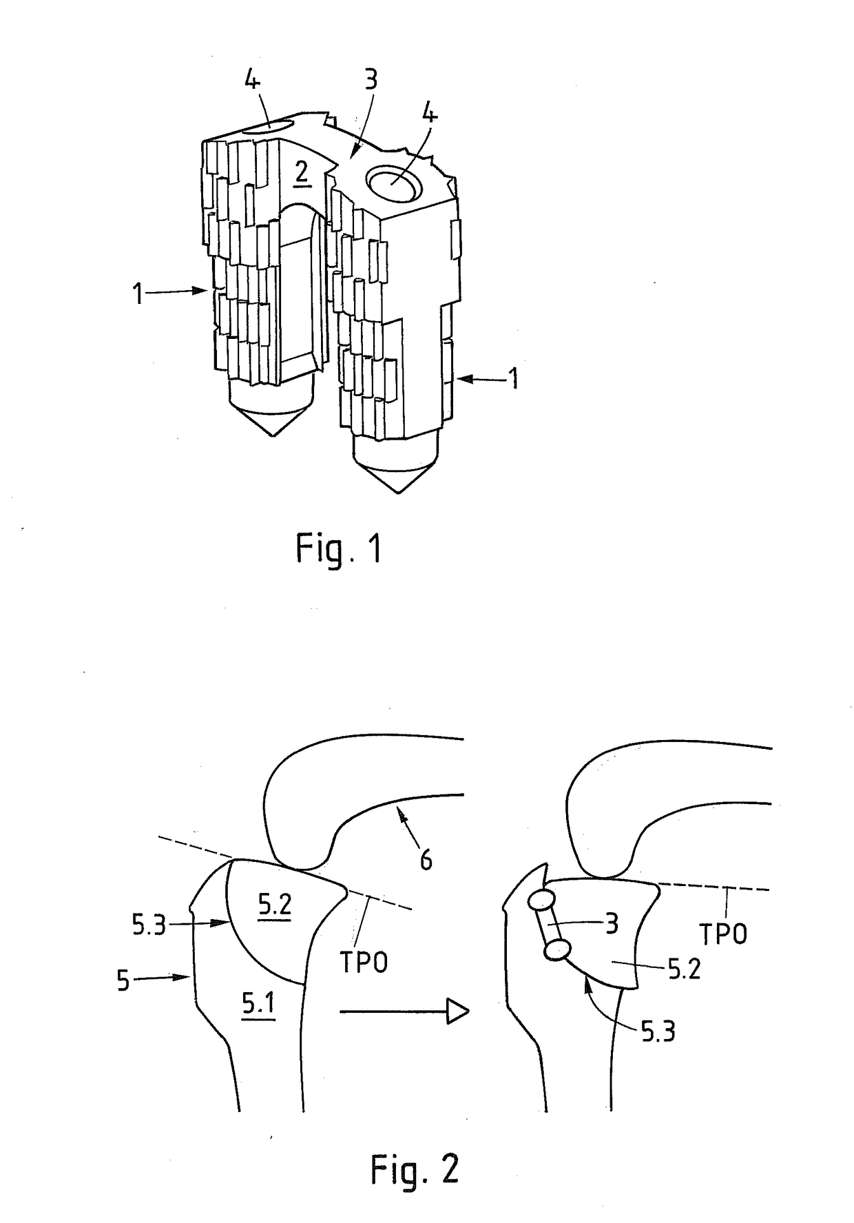 Method and implant for stabilizing two bone portions separated by a cut or fracture