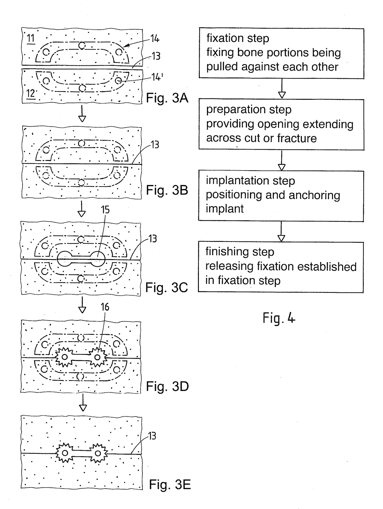 Method and implant for stabilizing two bone portions separated by a cut or fracture