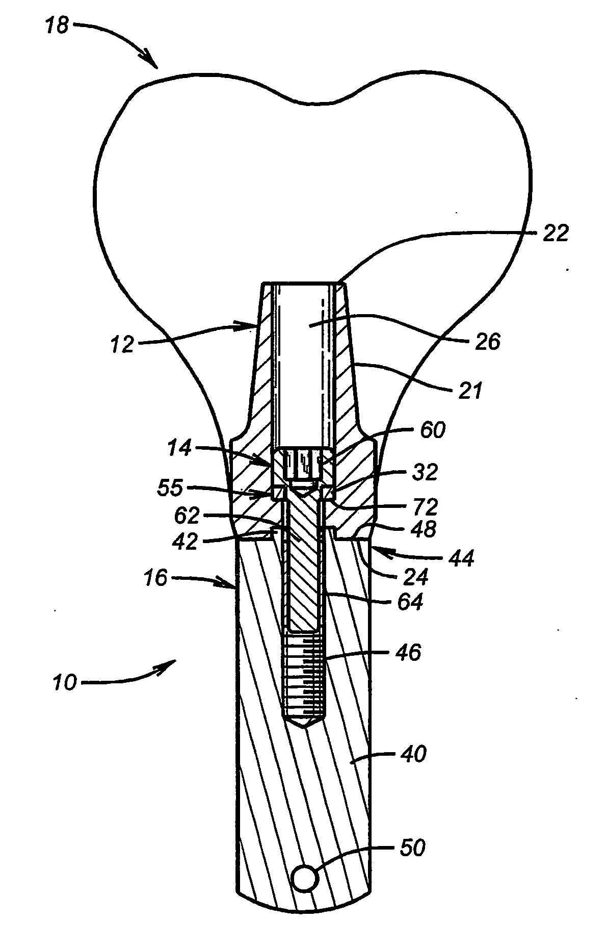 Abutment screw with spring-washer