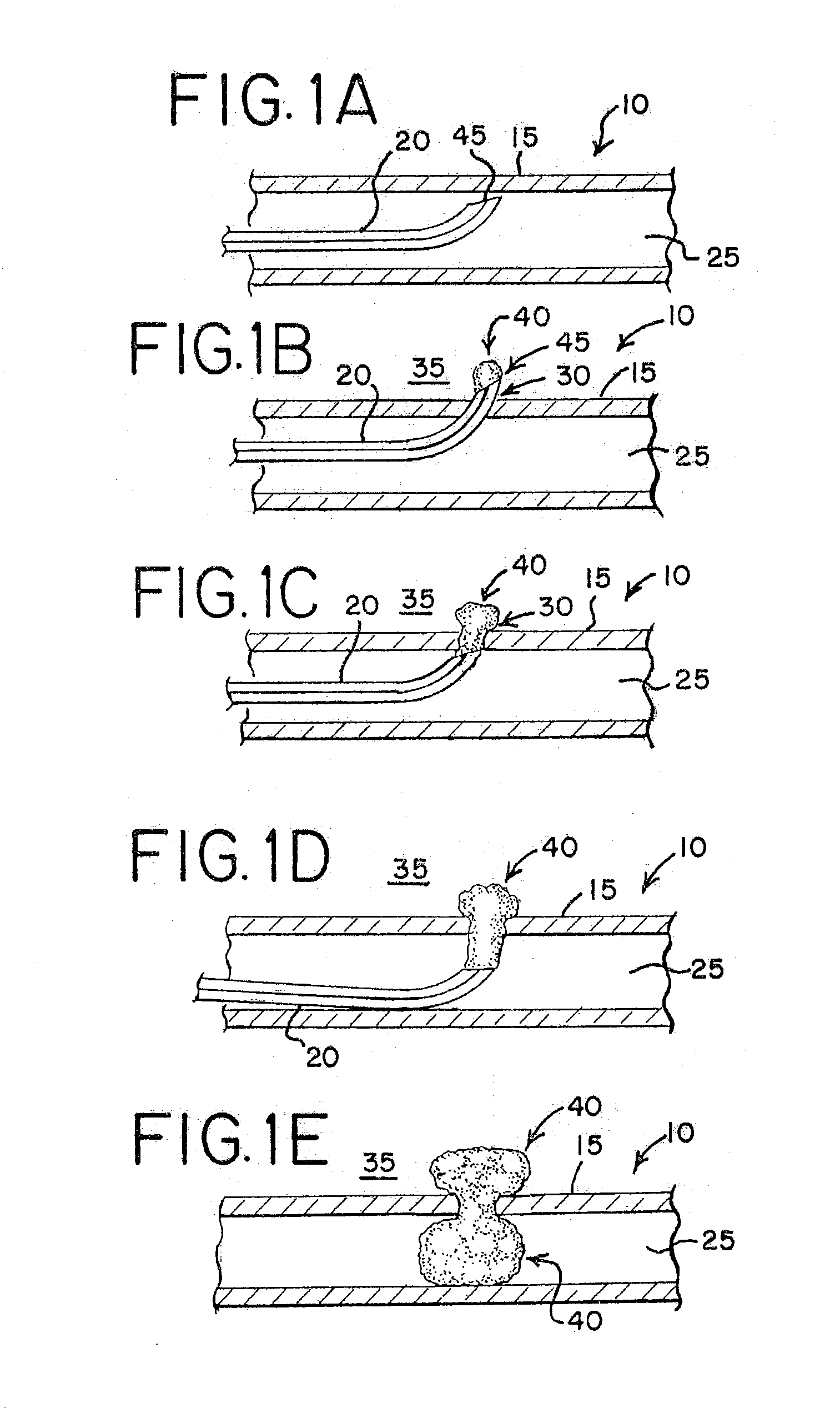 Method For Anchoring Occlusion Plug