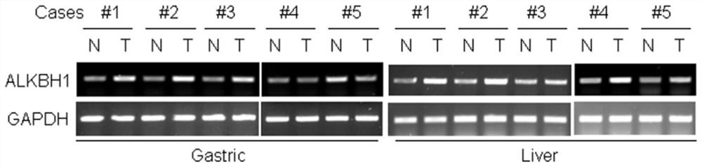 Application of alkbh1 gene and its expression product in the preparation of kits for diagnosing tumors and drugs for treating tumors