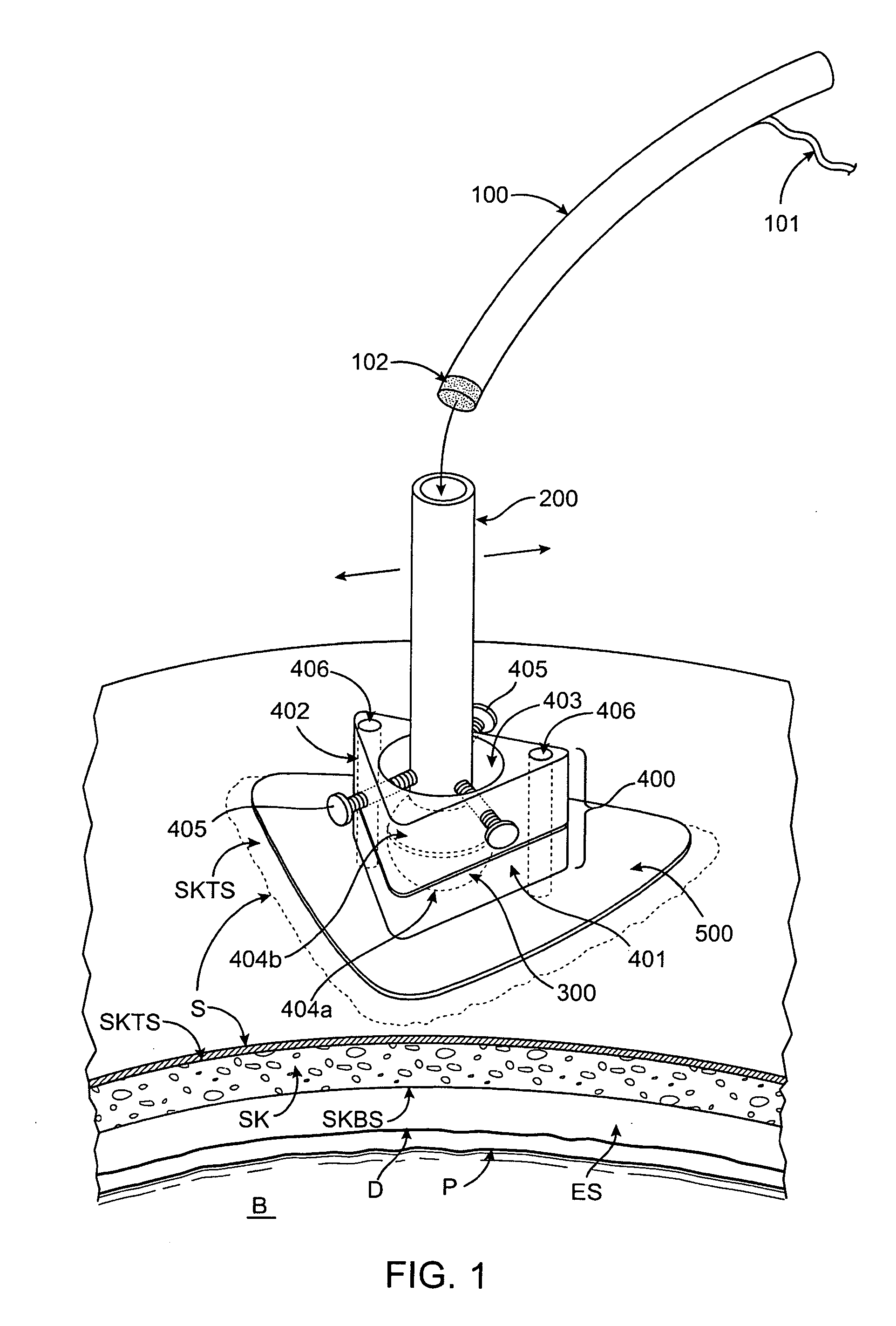 Methods and systems for ultrasound delivery through a cranial aperture