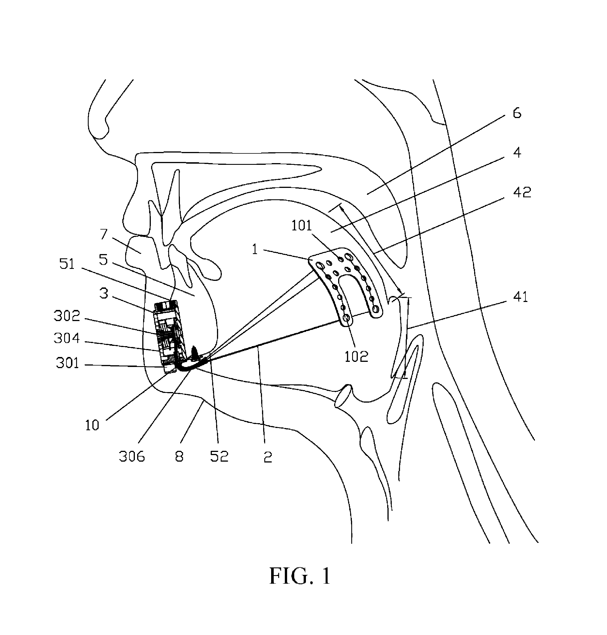 Implanted tongue pulling device, pull plate, pull line, retractor and method