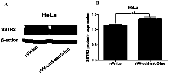 Recombinant poxvirus containing ccl5 and sstr2 genes and preparation method thereof