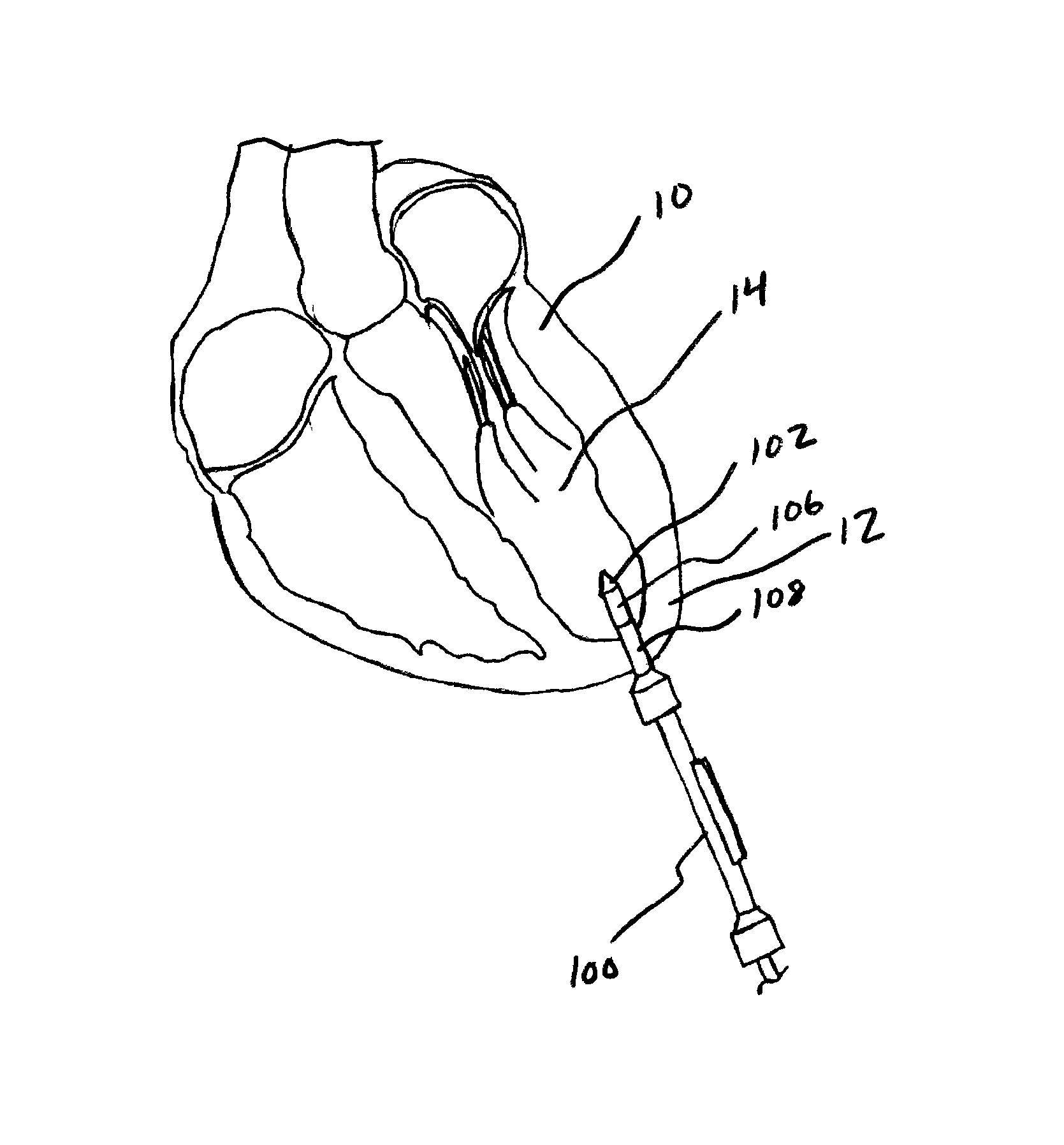 Exchangeable system for minimally invasive beating heart repair of heart valve leaflets