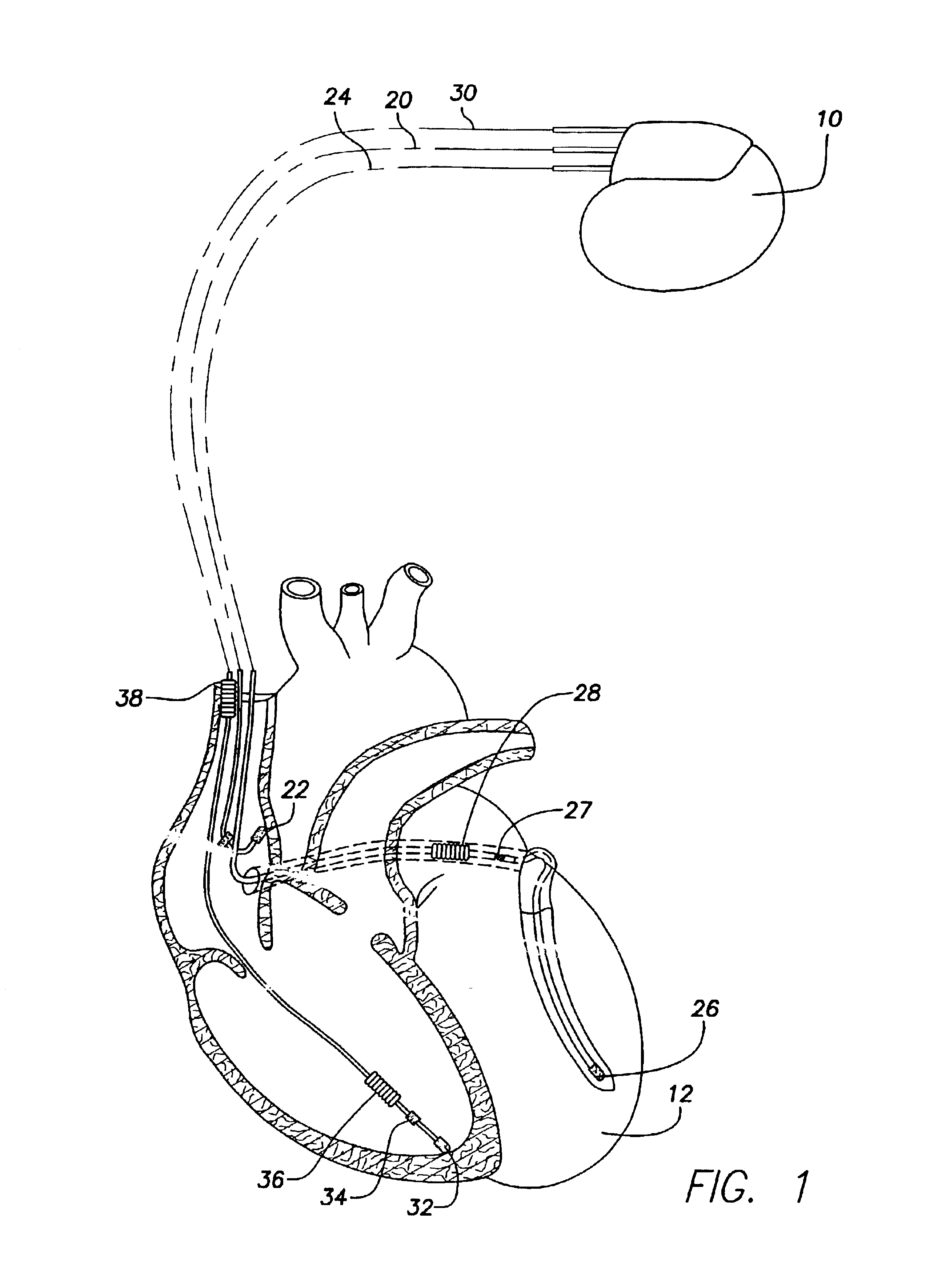 Implantable medical device and method for detecting cardiac events without using of refractory or blanking periods