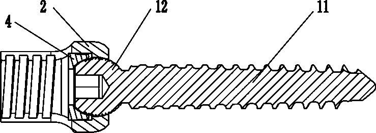 A pedicle screw