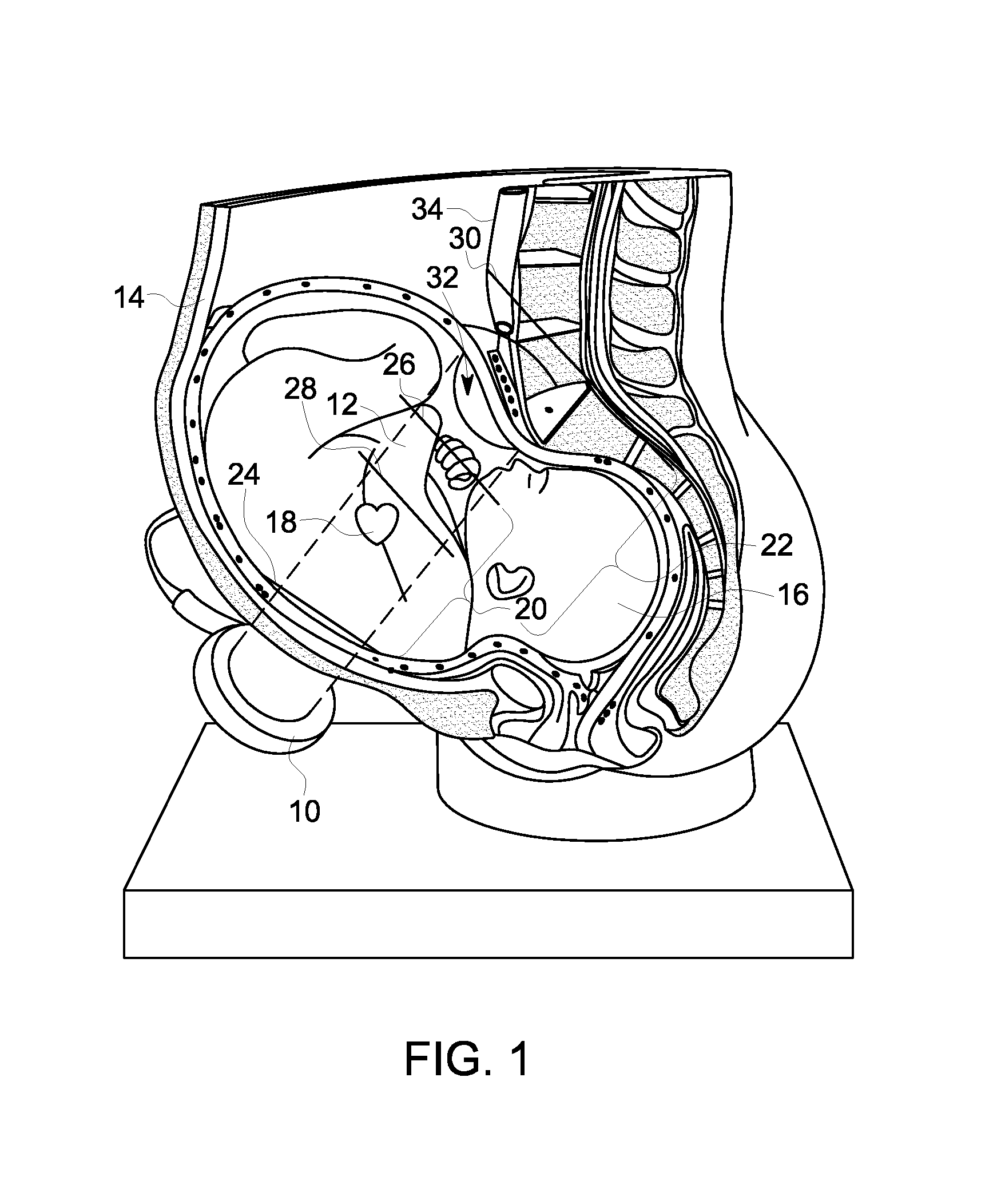 Method and device for fetal heart rate monitoring with maternal contribution detection