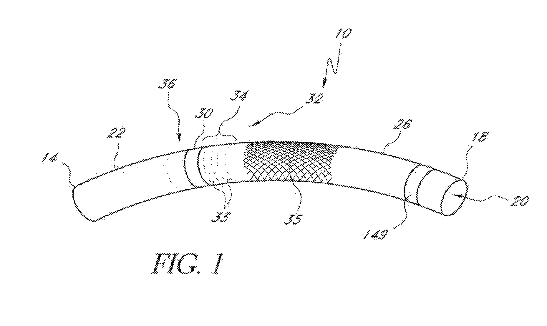 Implantable and removable customizable body conduit