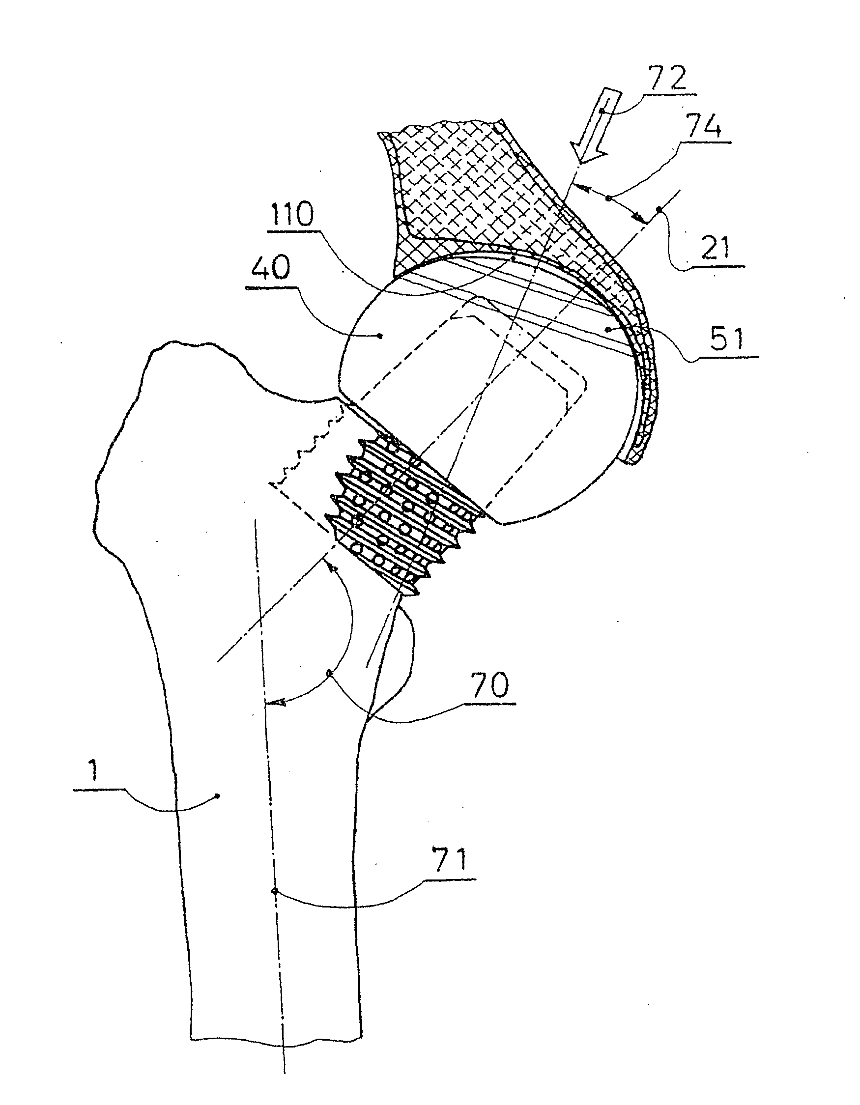 Partial hip prosthesis