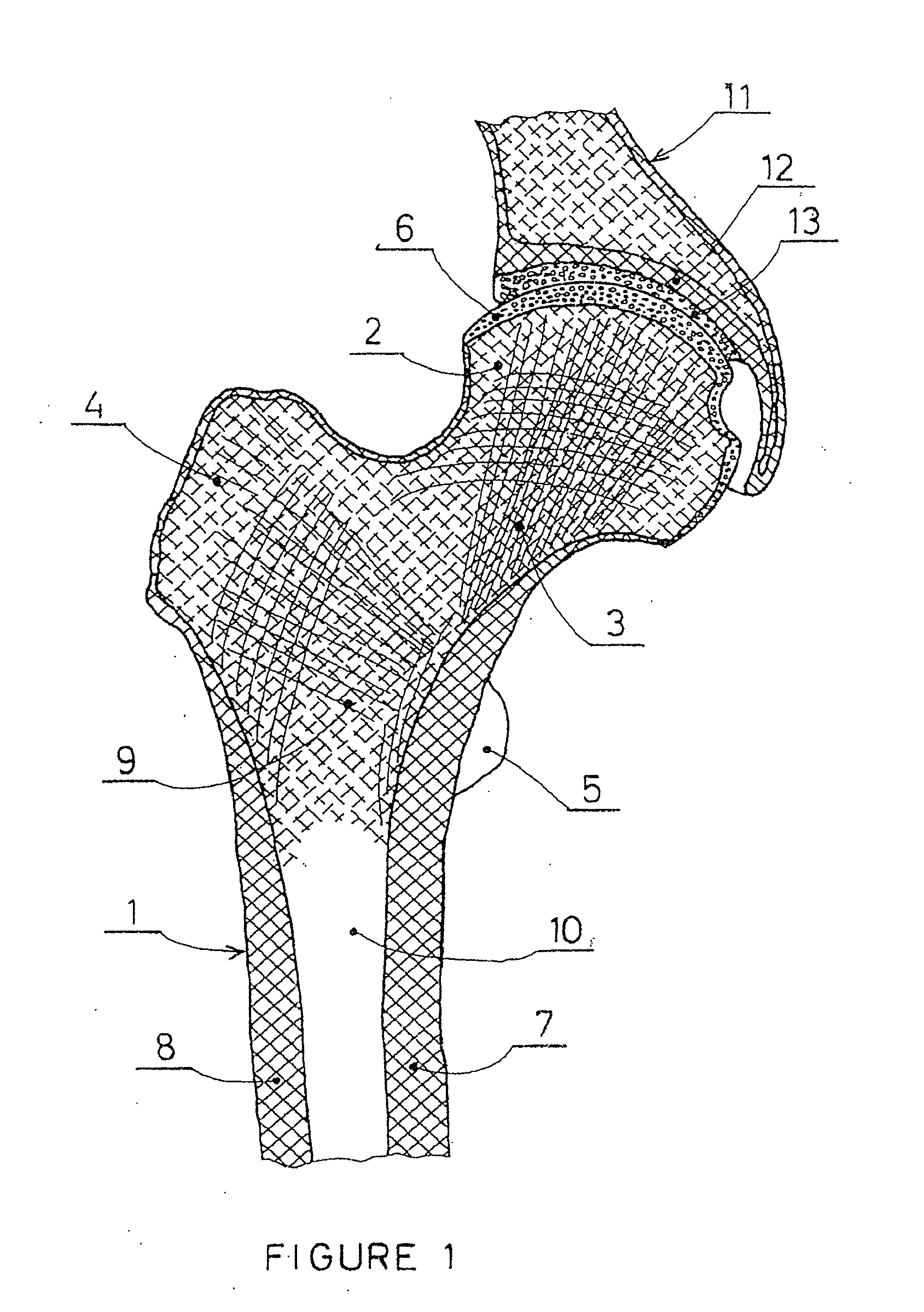 Partial hip prosthesis