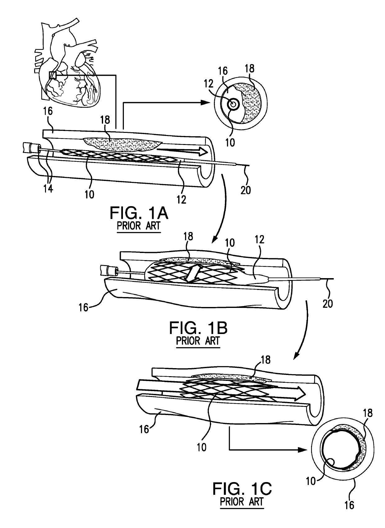 Intravascular delivery system and method for percutaneous coronary intervention