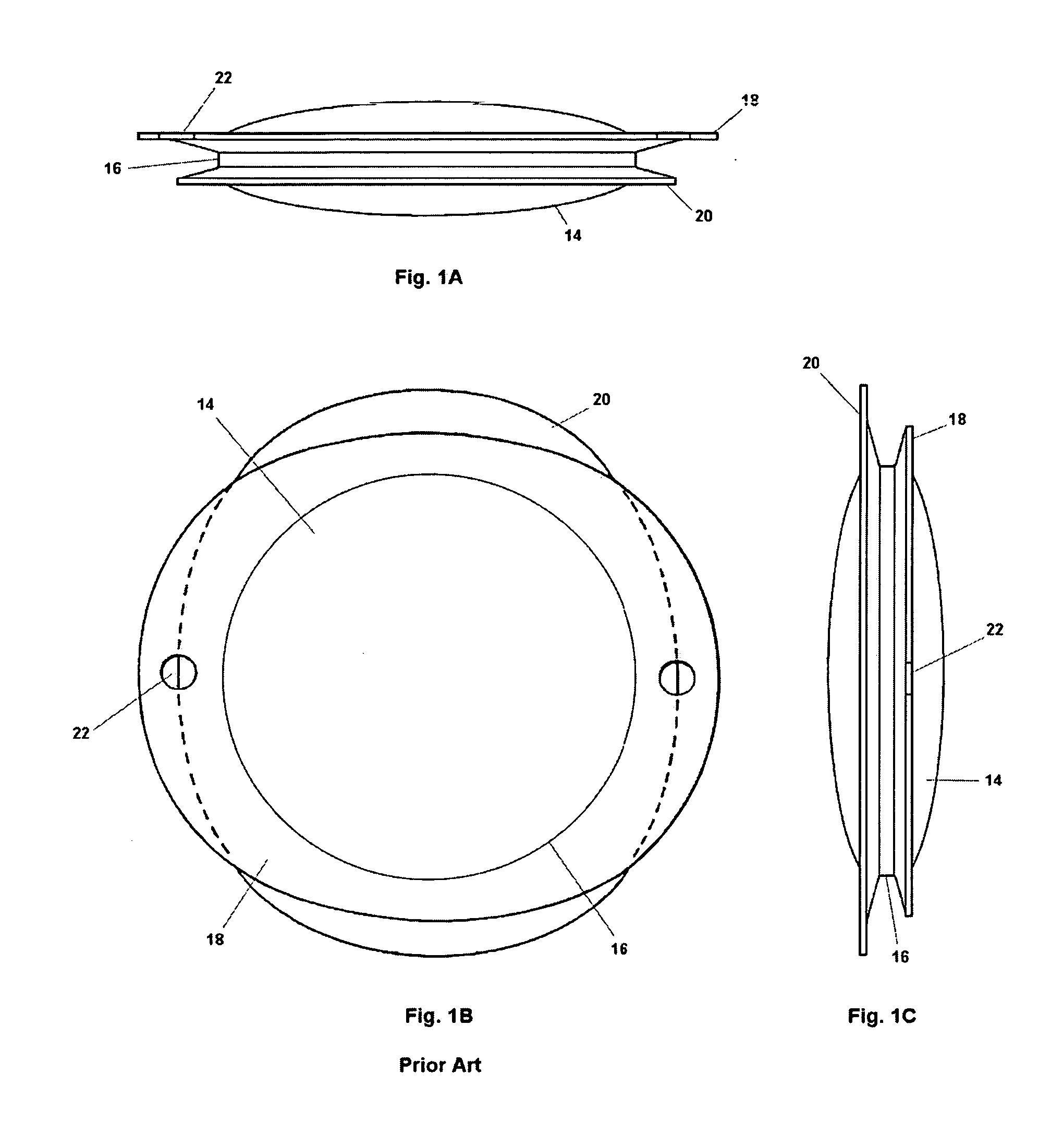 Bag-in-the-lens intraocular lens with removable optic and capsular accommodation ring