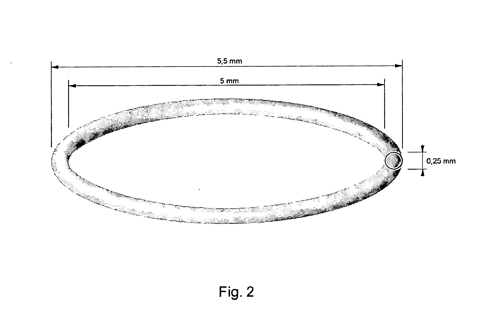 Bag-in-the-lens intraocular lens with removable optic and capsular accommodation ring