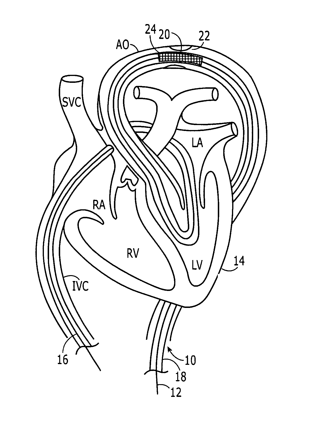Separable sheath and method for insertion of a medical device into a bodily vessel using a separable sheath
