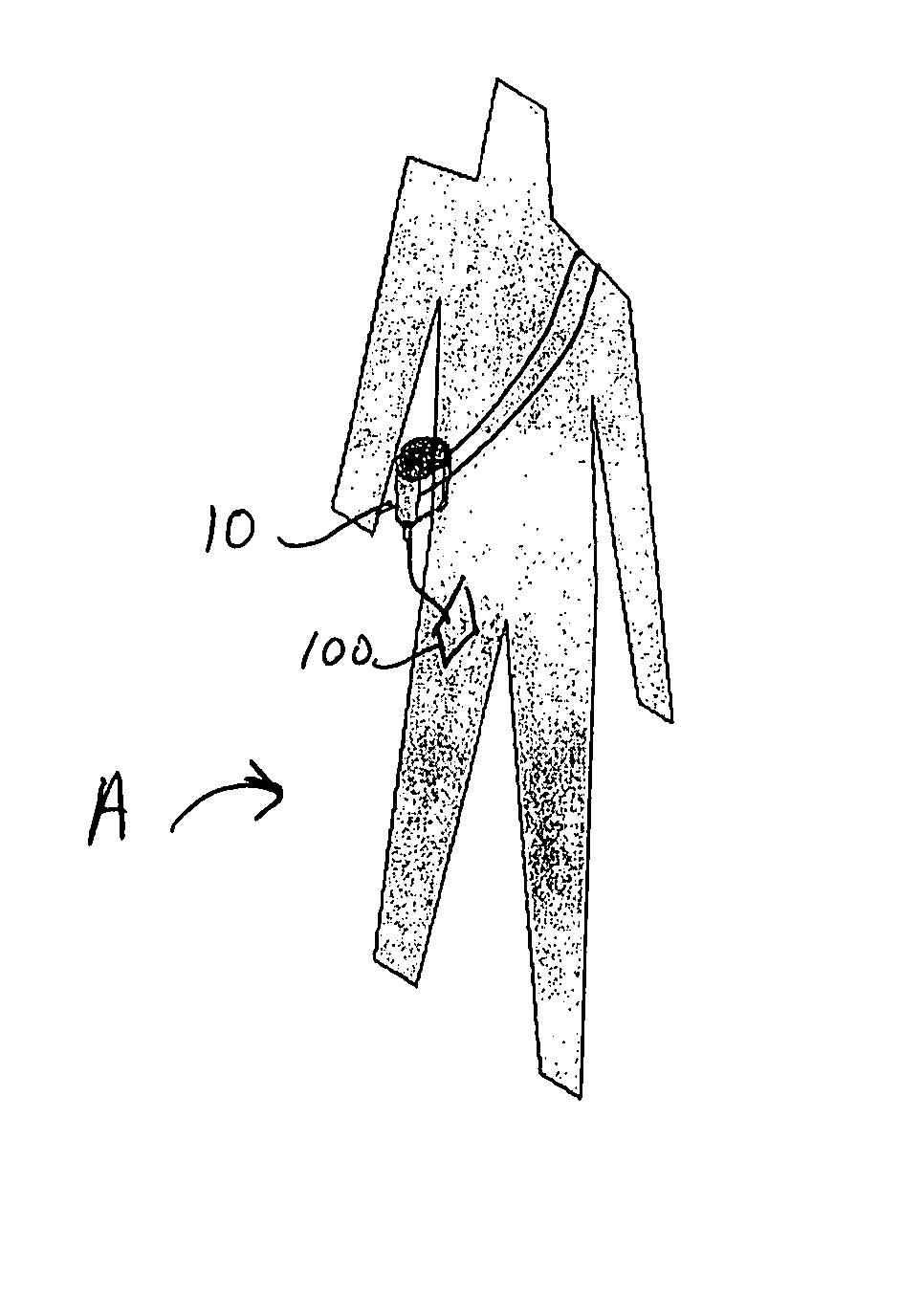 Negative pressure wound treatment device, and methods