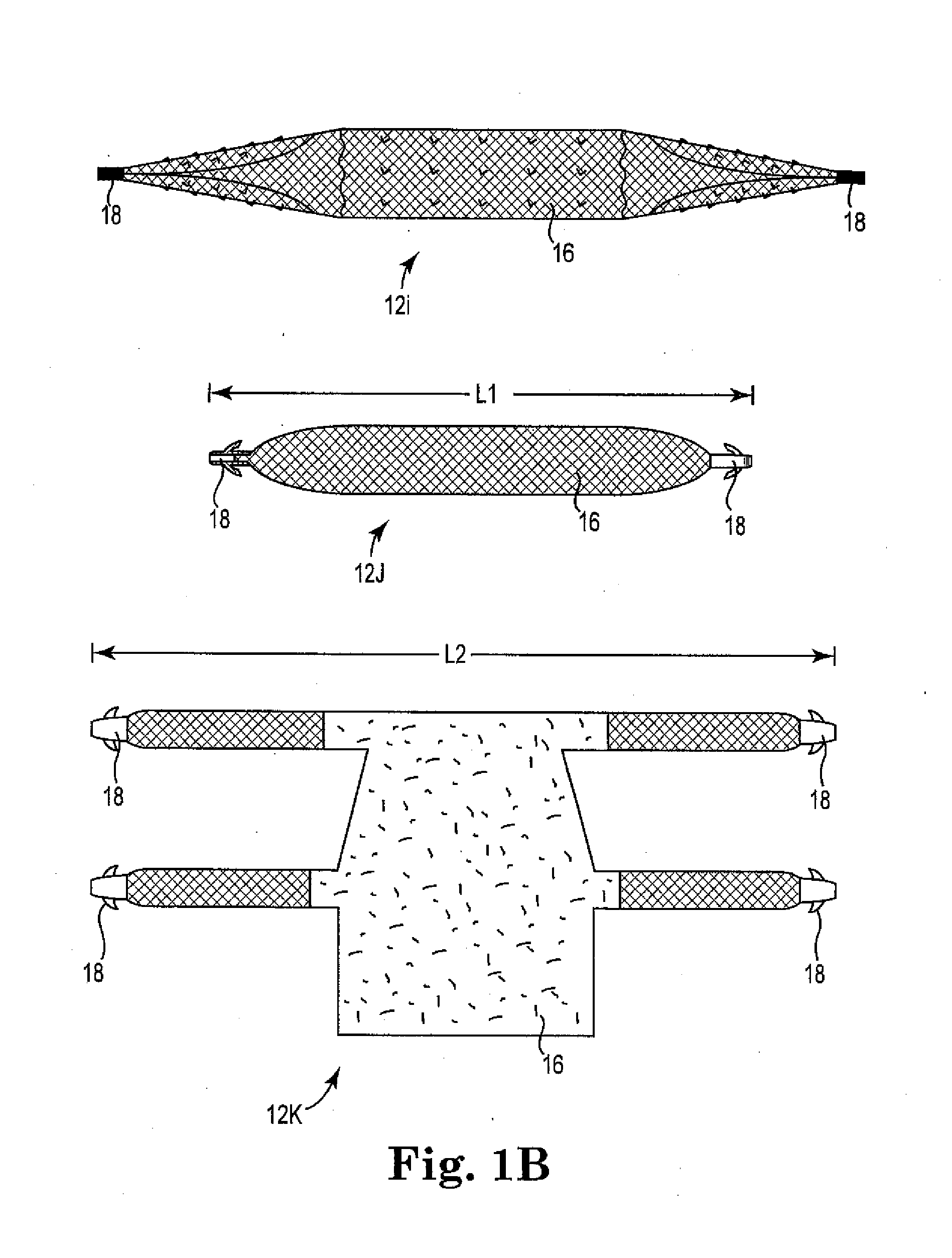 Surgical tools, systems, and related implants and methods