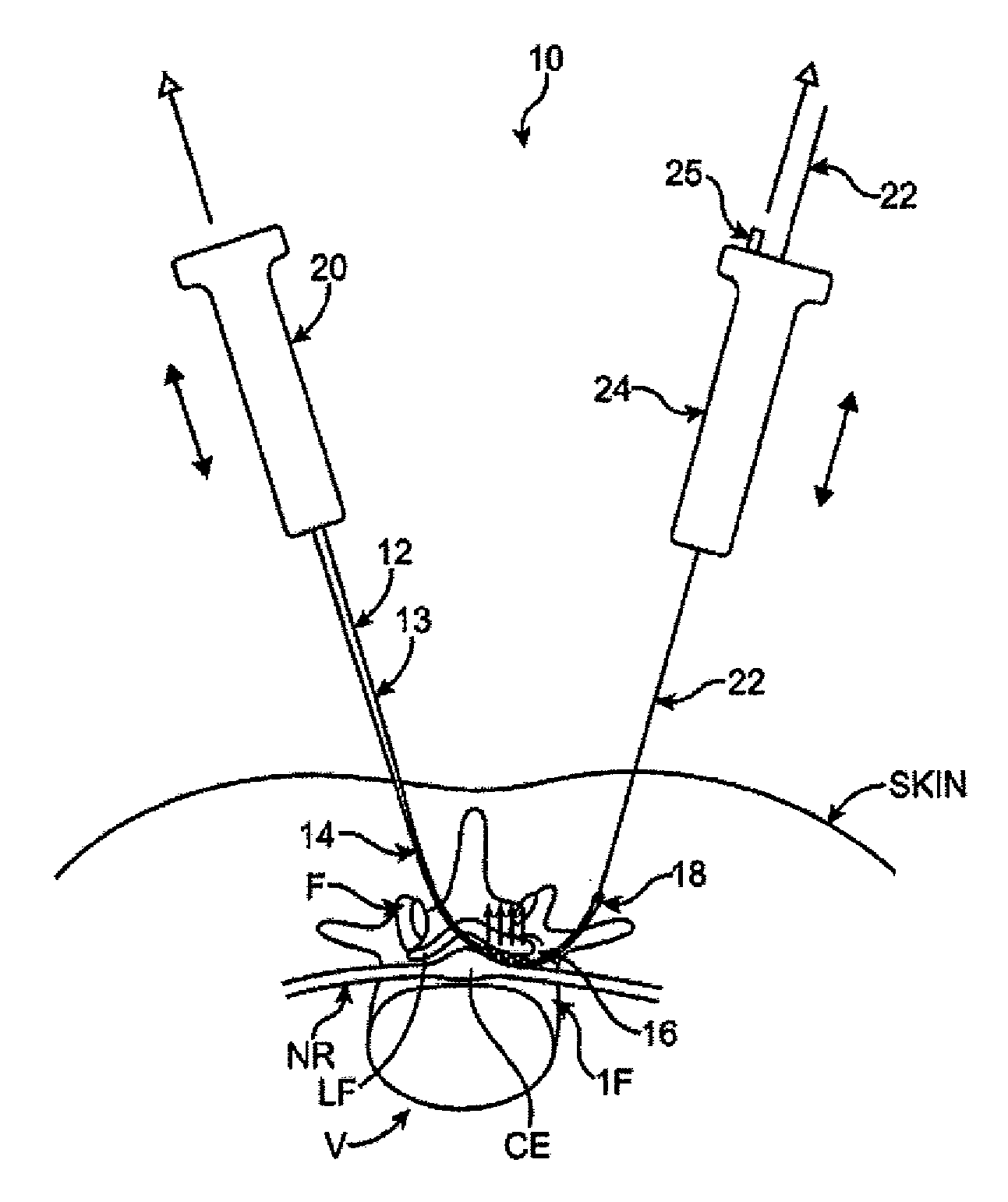 Tissue removal devices and methods