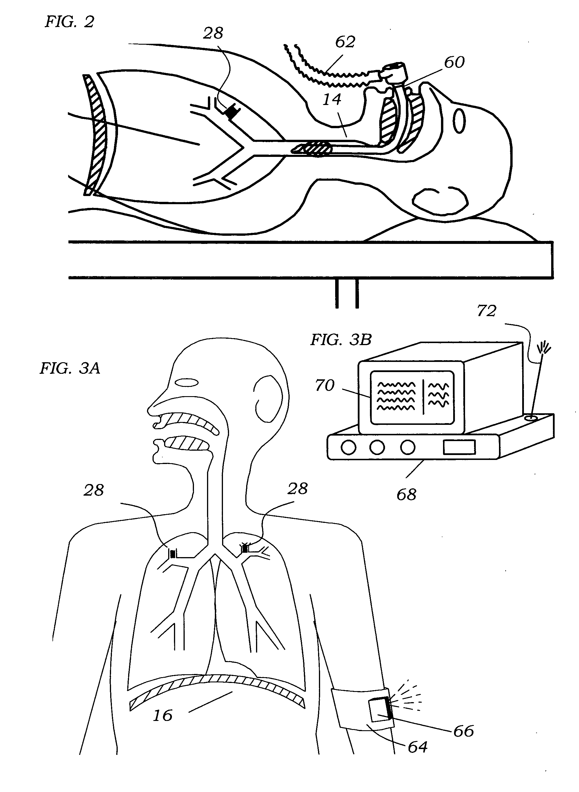 Methods, systems & devices for endobronchial ventilation and drug delivery