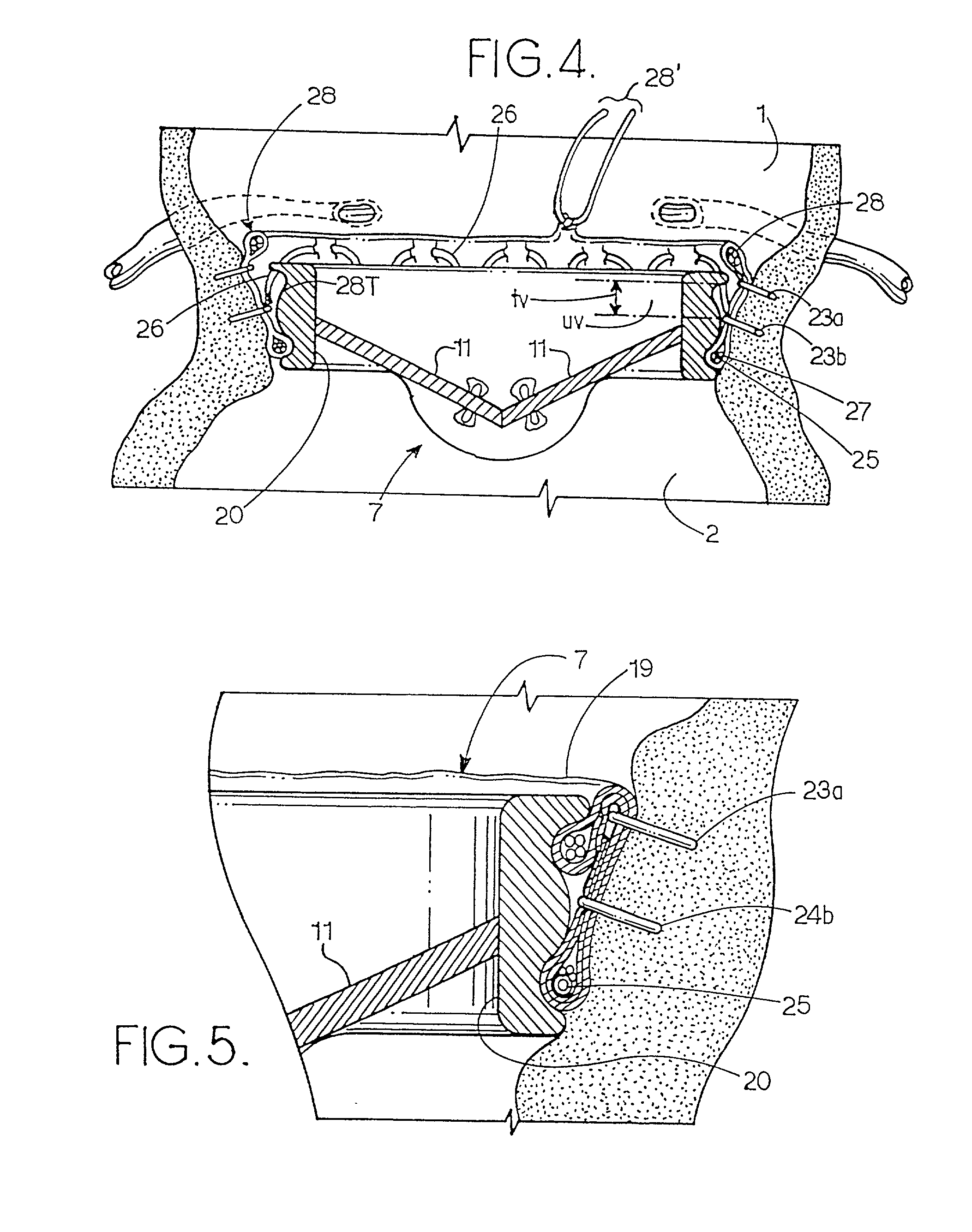 Means and method of replacing a heart valve in a minimally invasive manner