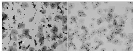 An automatic identification method for abnormal cervical cells based on a novel Pap staining method