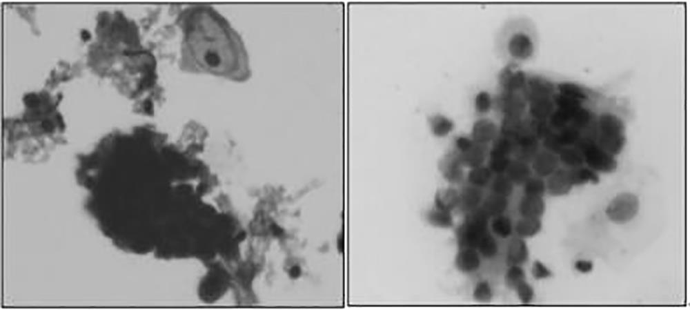 An automatic identification method for abnormal cervical cells based on a novel Pap staining method