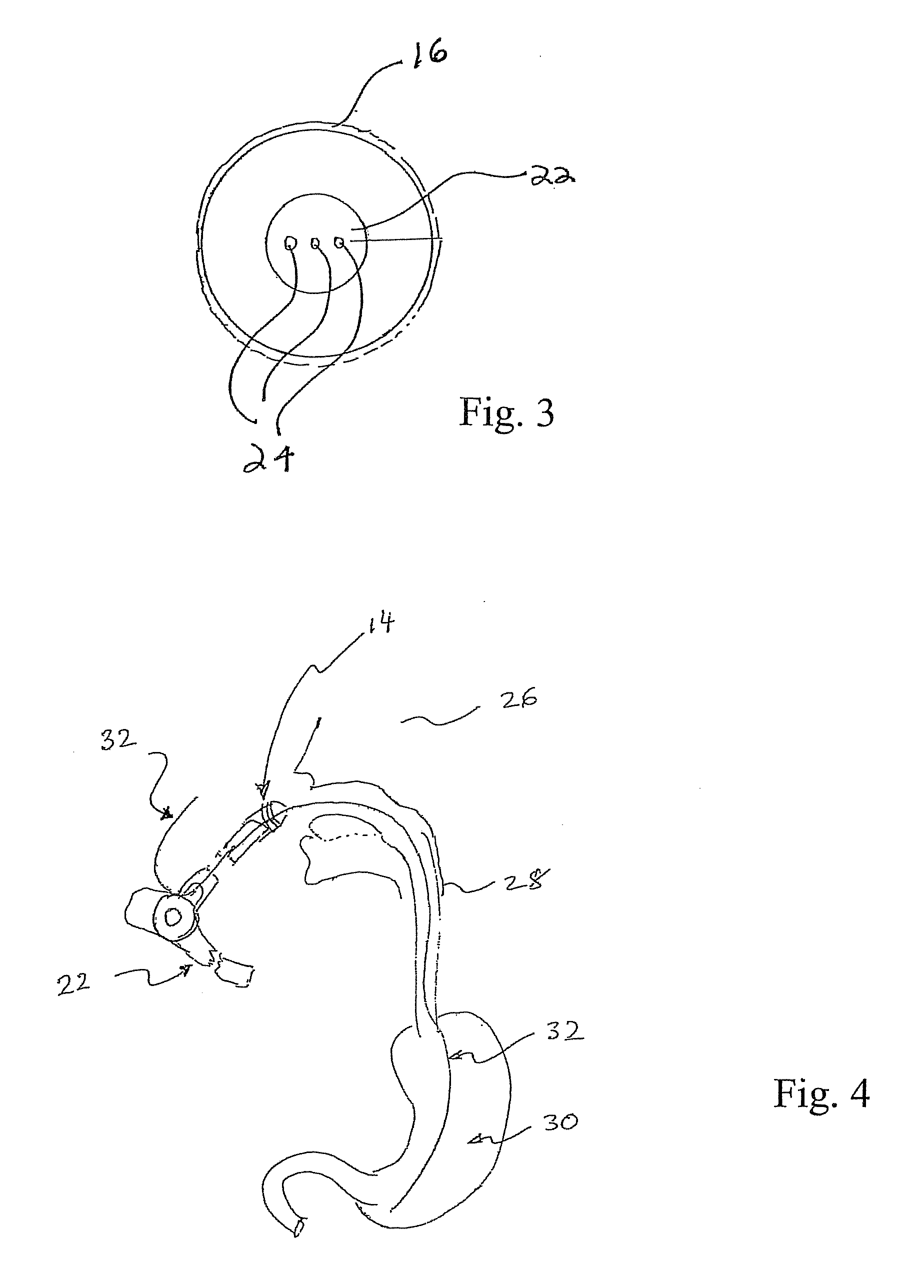 Endoscopic full thickness gastric reduction apparatus and method