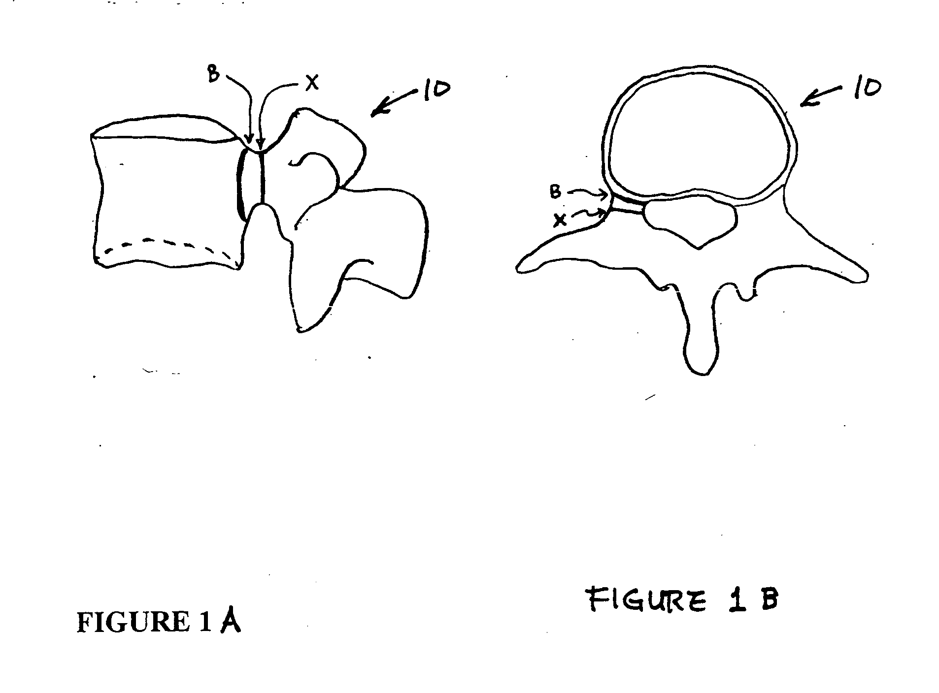 Methods for determining pedicle base circumference, pedicle isthmus and center of the pedicle isthmus for pedicle screw or instrument placement in spinal surgery