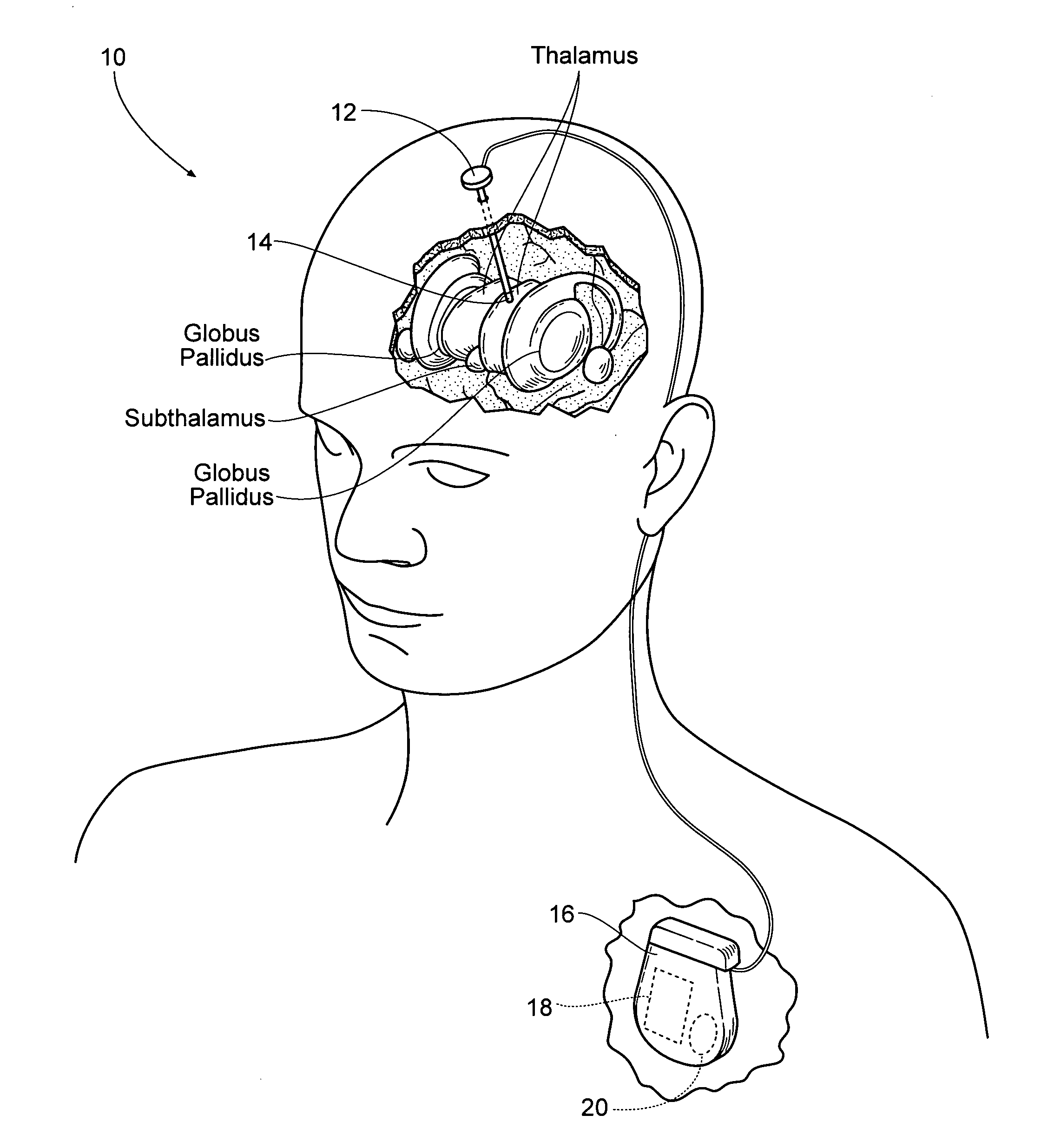 Non-regular electrical stimulation patterns for treating neurological disorders