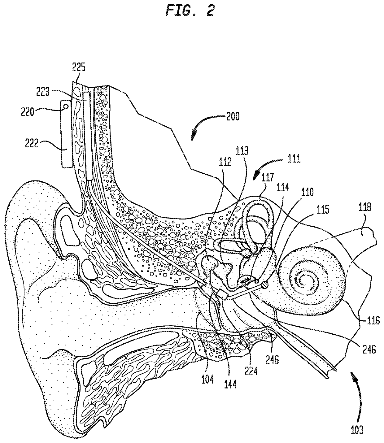 Intra-operative determination of vibratory coupling efficiency