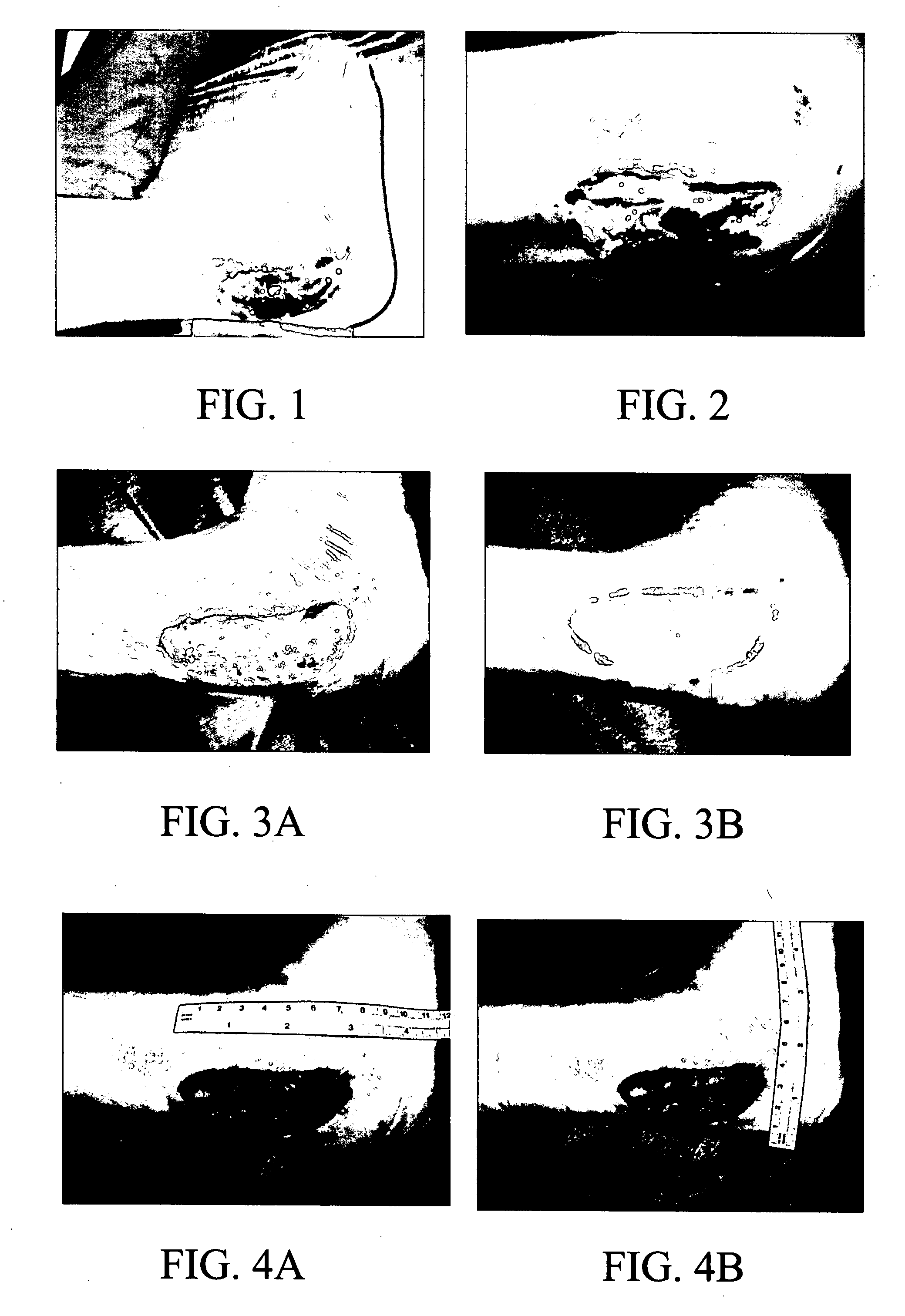 Materials and methods for wound treatment