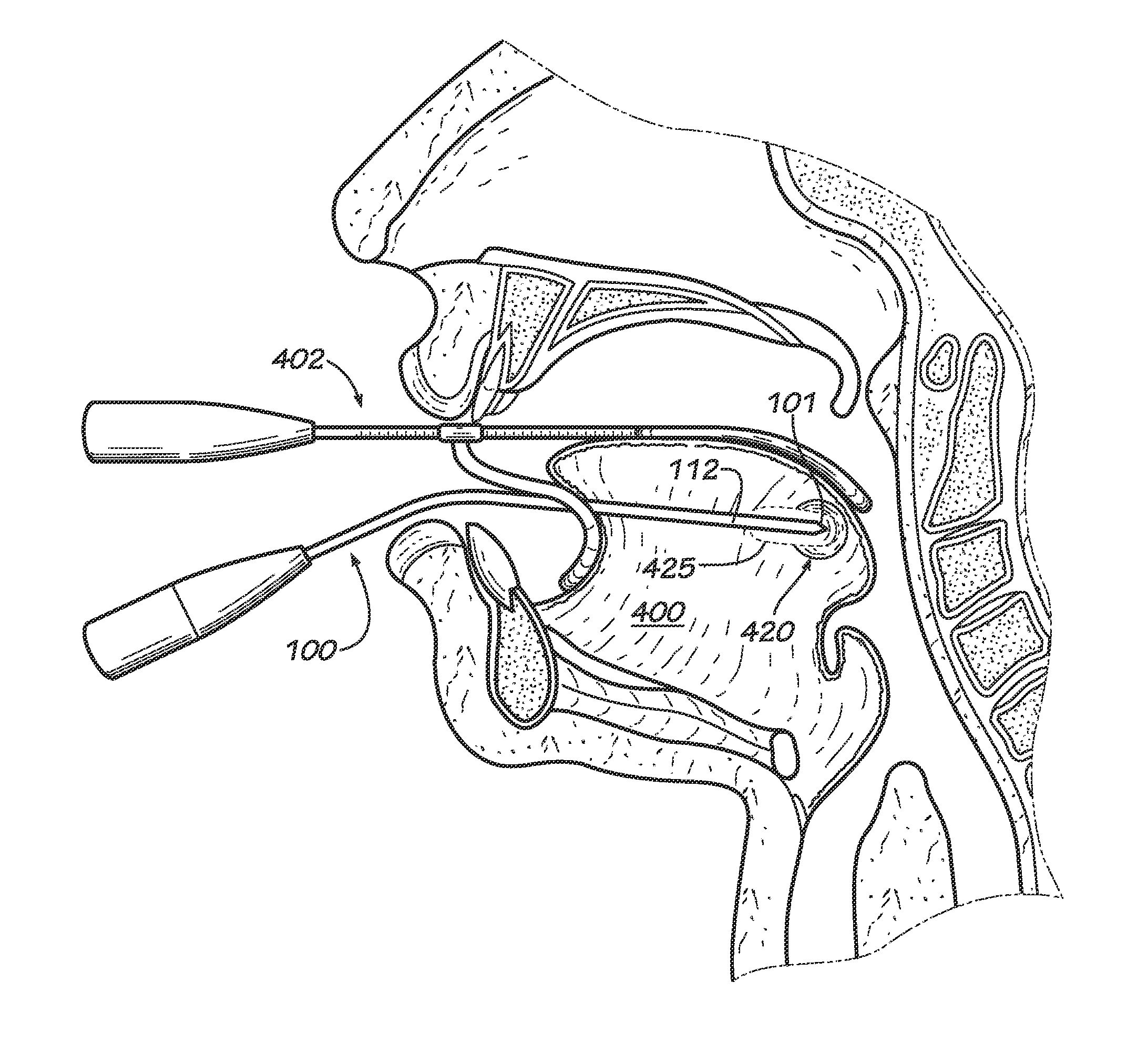 Apparatus and Method for Ventral Only Ablation of the Tongue