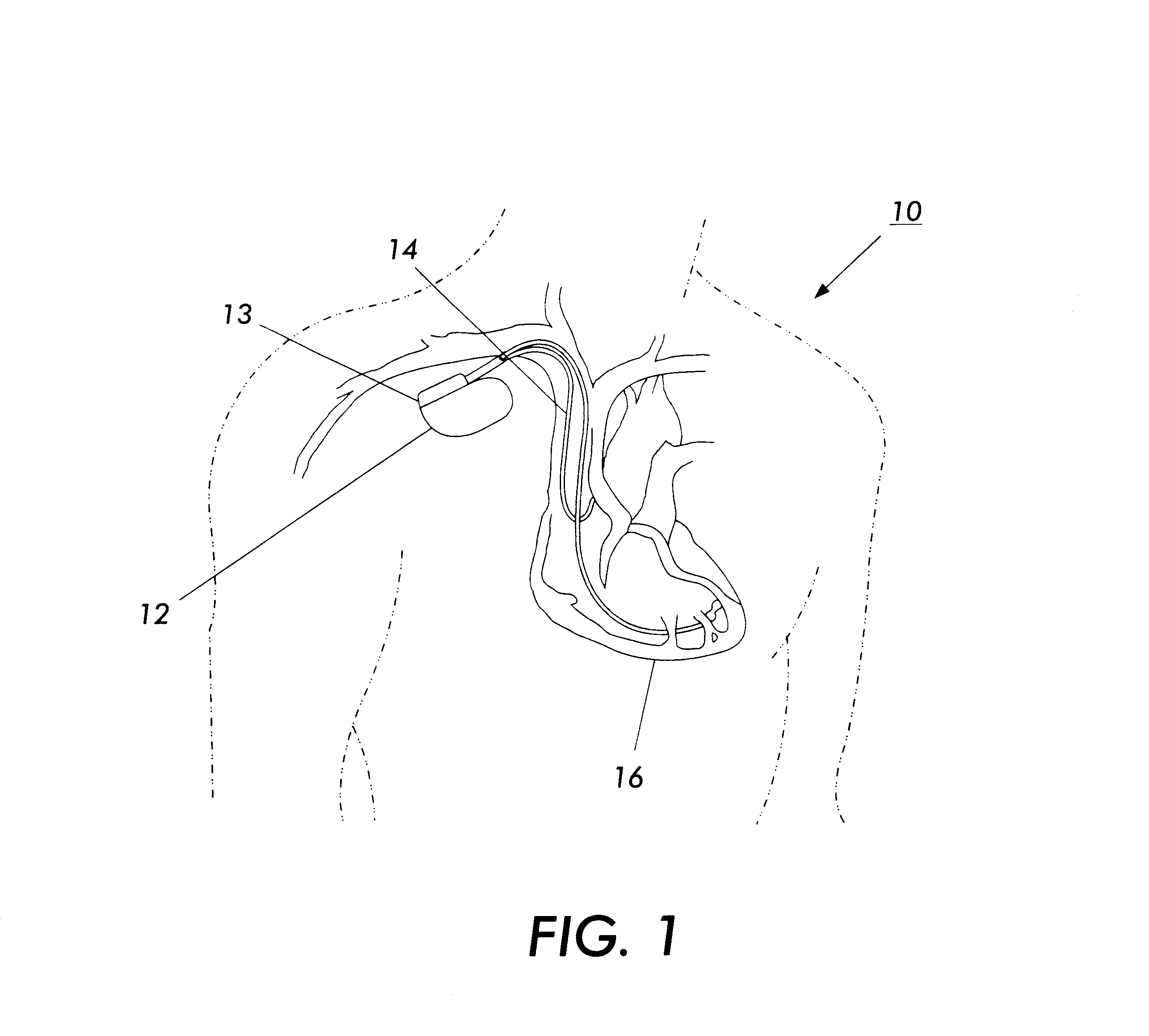 Electromagnetic radiation immune medical assist device adapter