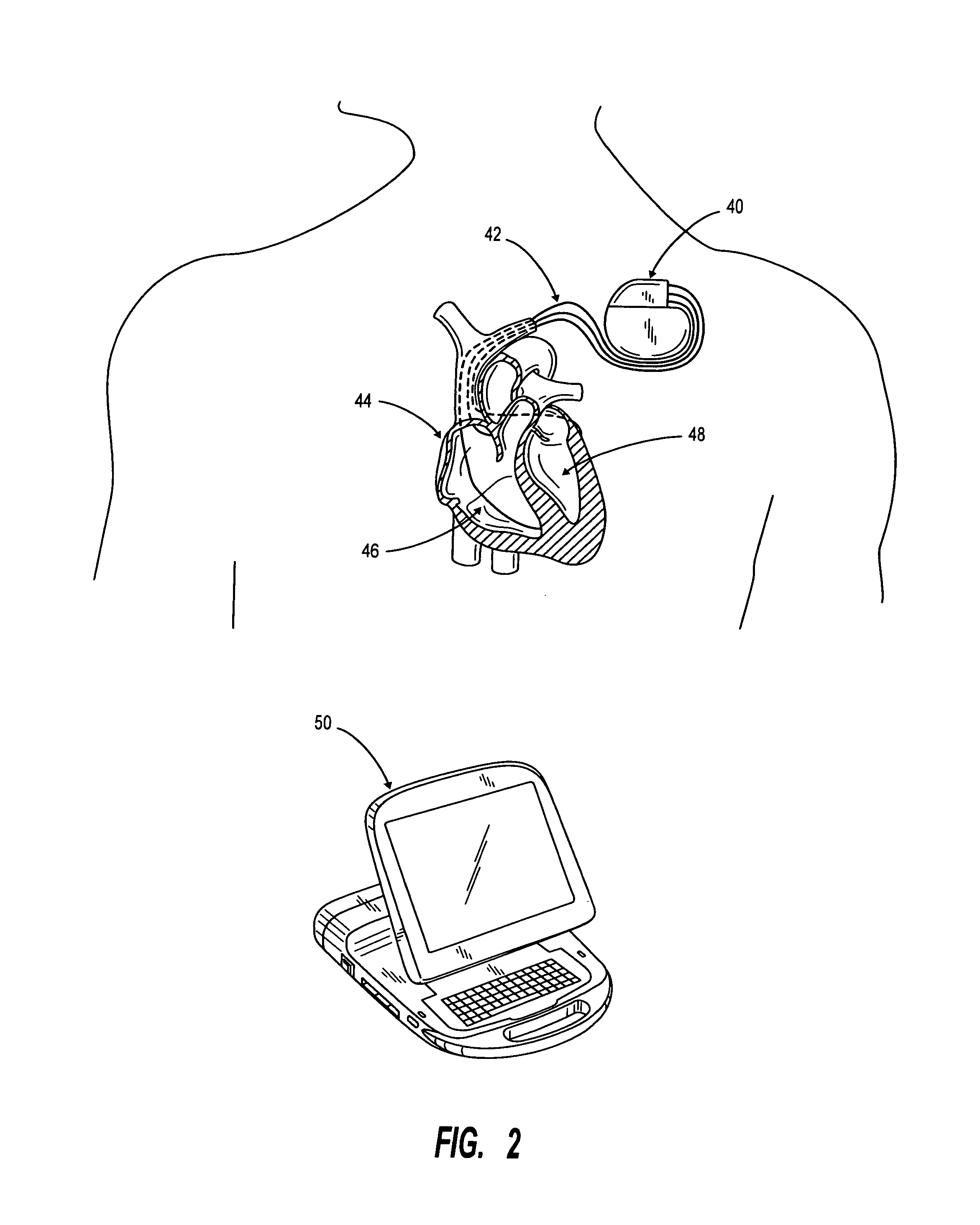 Method of optimizing patient outcome from cardiac resynchronization therapy