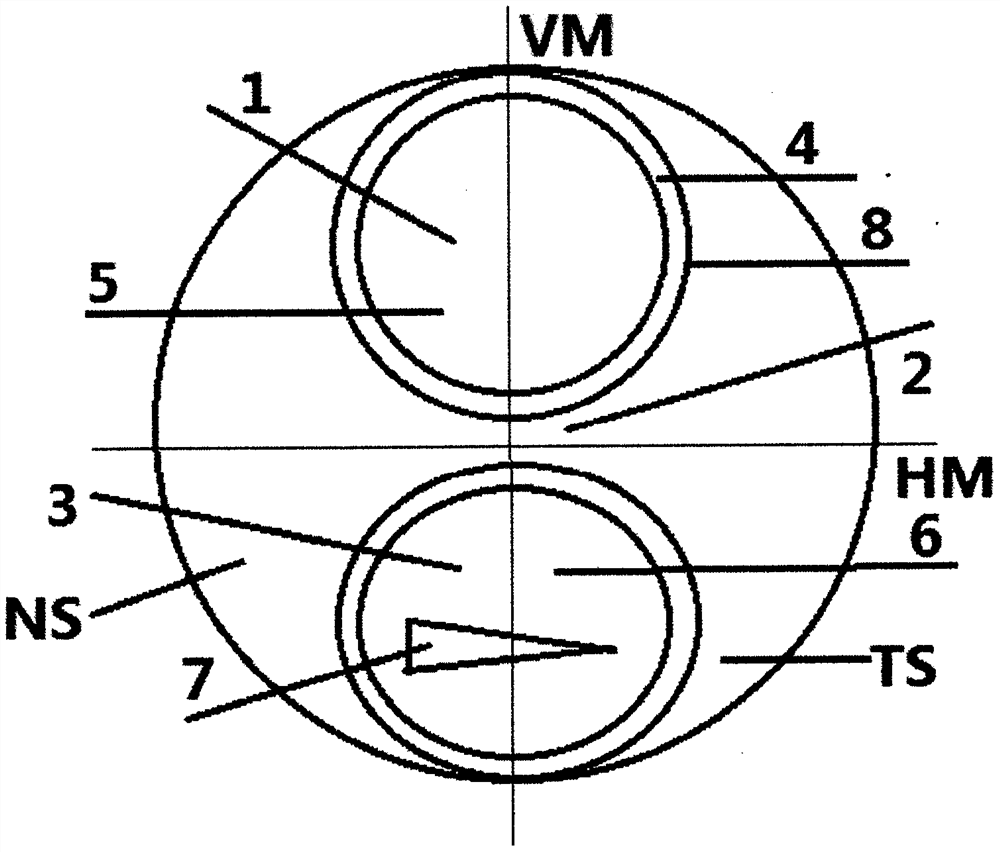 Individualized three-focus frame spectacle lens