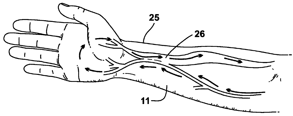 Method and apparatus for enhancing the maturation rate of an arteriovenous fistula