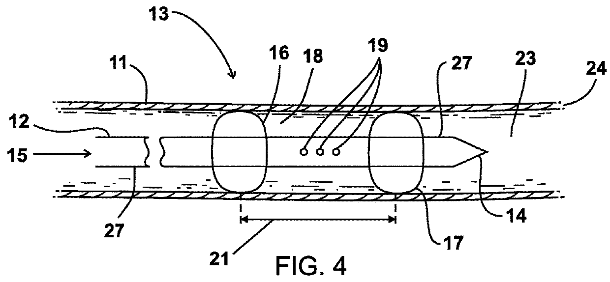 Method and apparatus for enhancing the maturation rate of an arteriovenous fistula