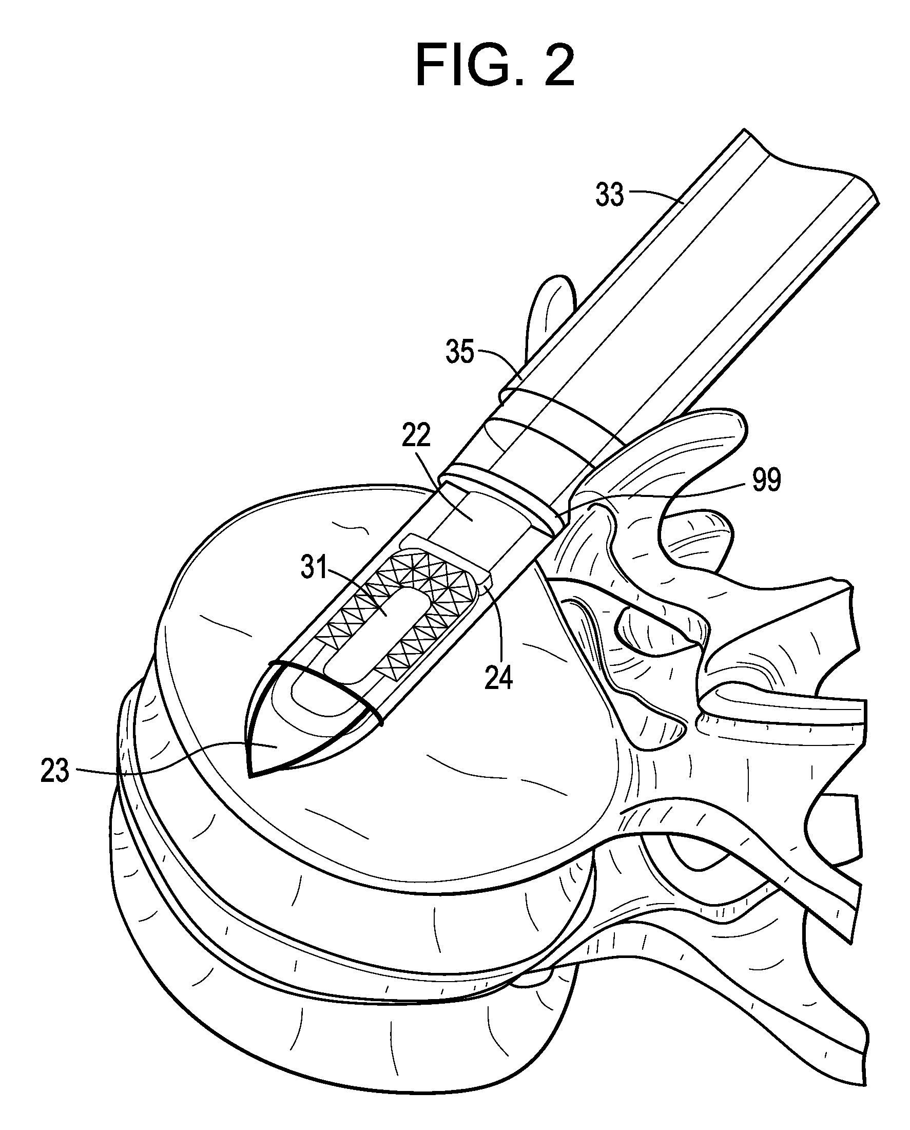 Enhanced cage insertion device