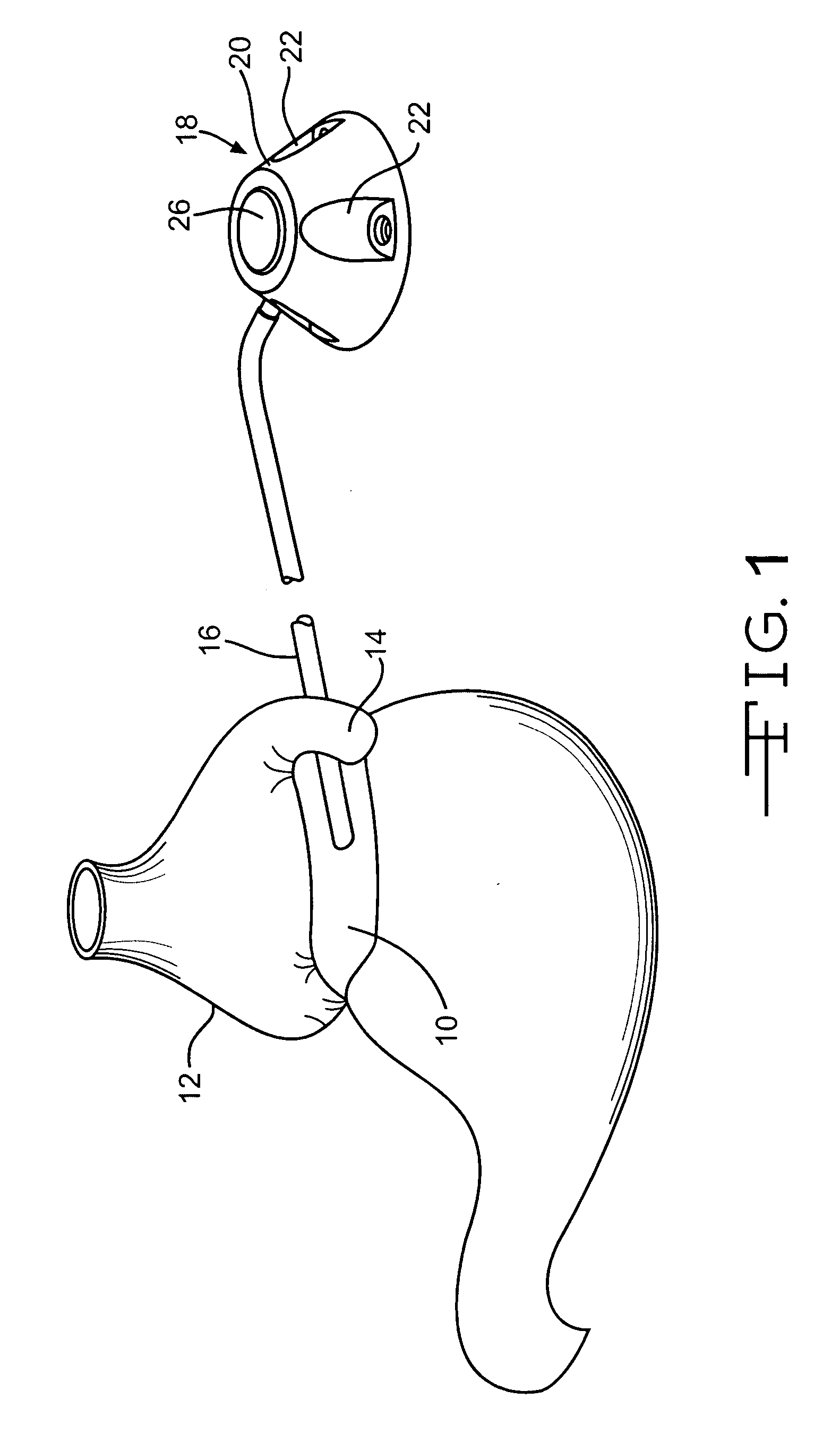 Subcutaneous injection port for applied fasteners