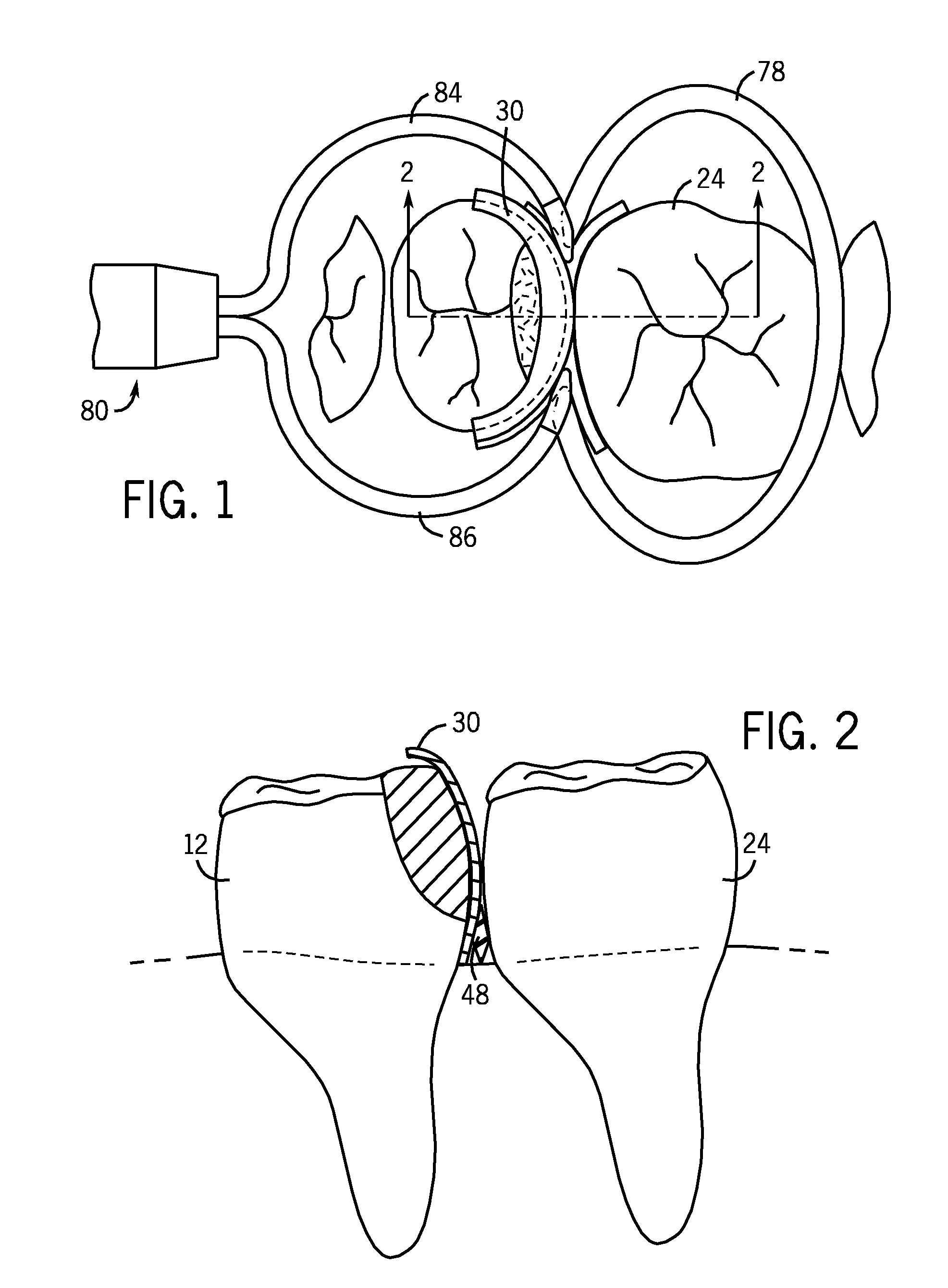 Dental Kits And A Seamless, Single Load Cavity Preparation And Filling Technique