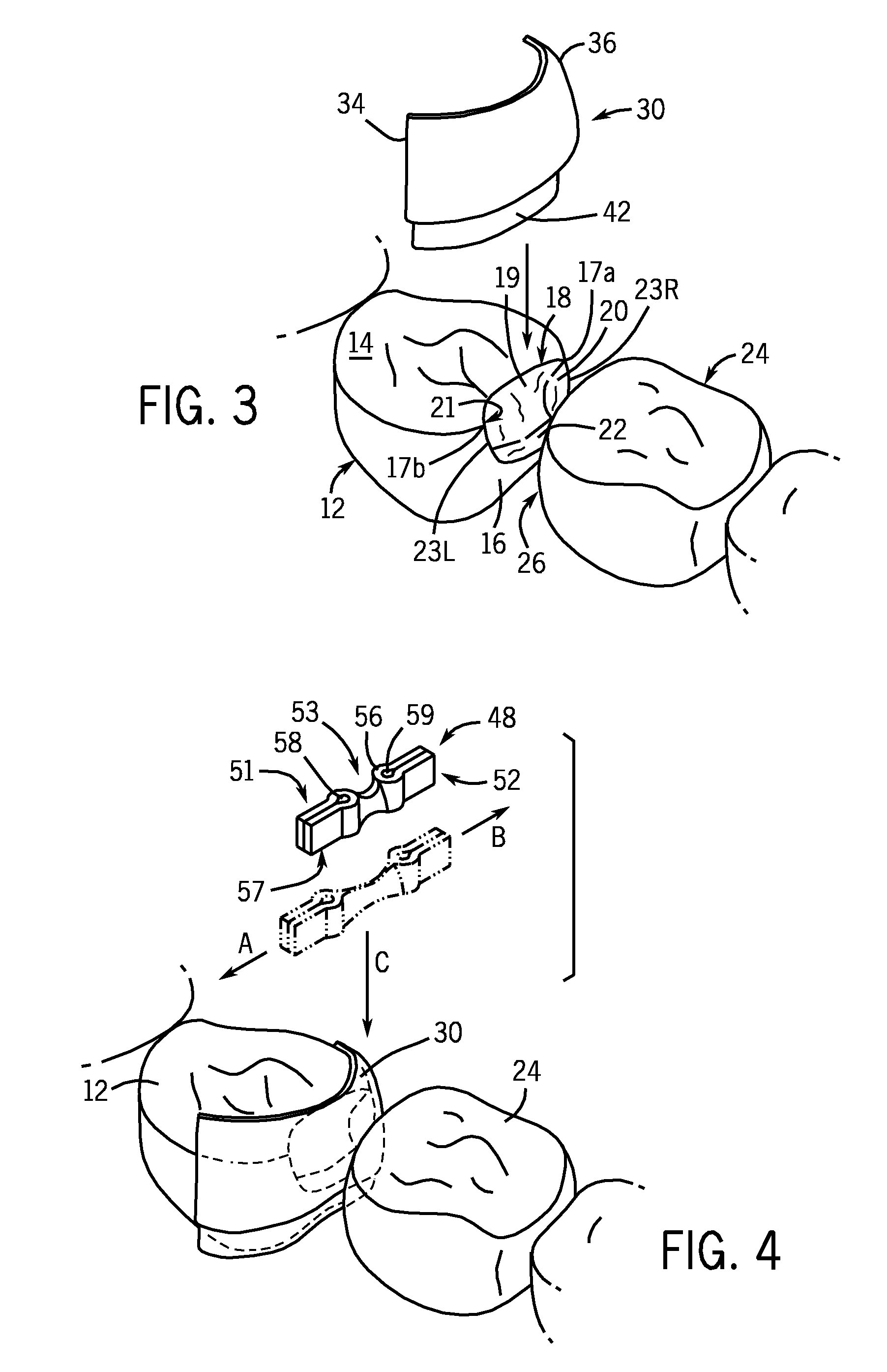 Dental Kits And A Seamless, Single Load Cavity Preparation And Filling Technique