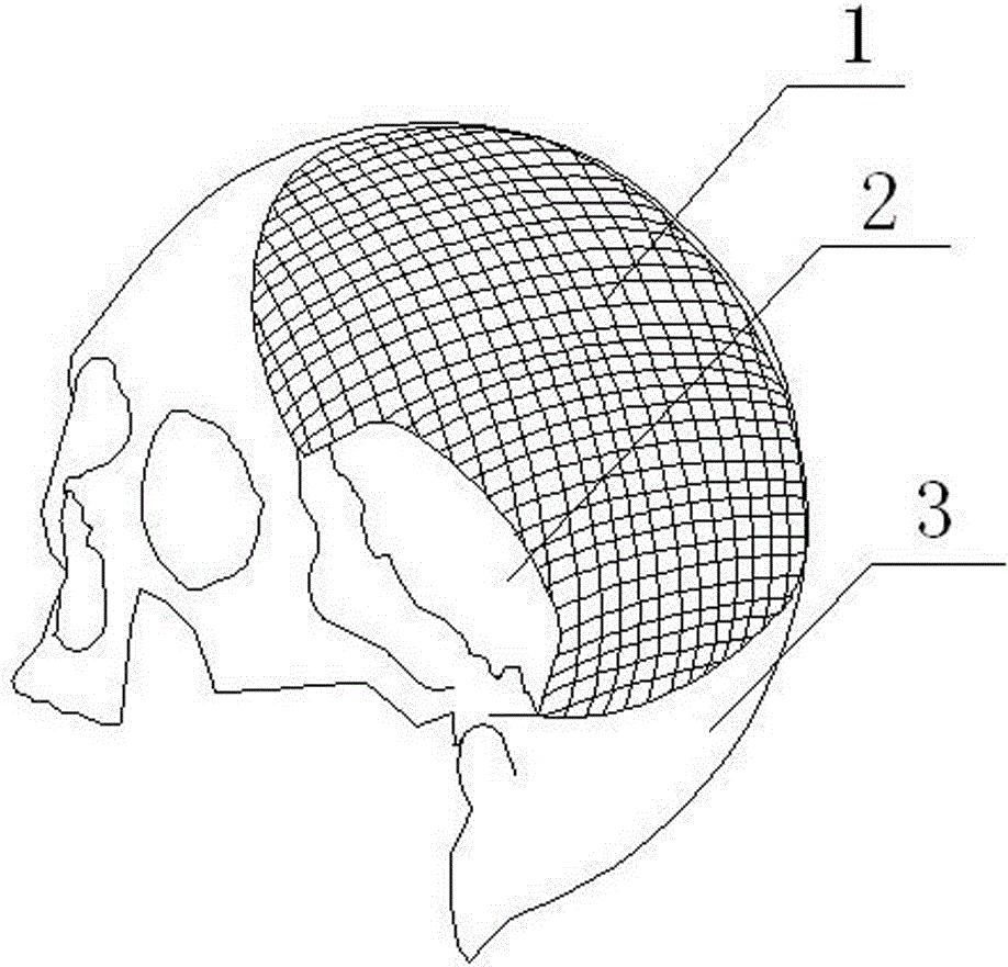 Craniocerebral three-dimensional plastic prosthesis with muscular pedicle window and preparation method thereof
