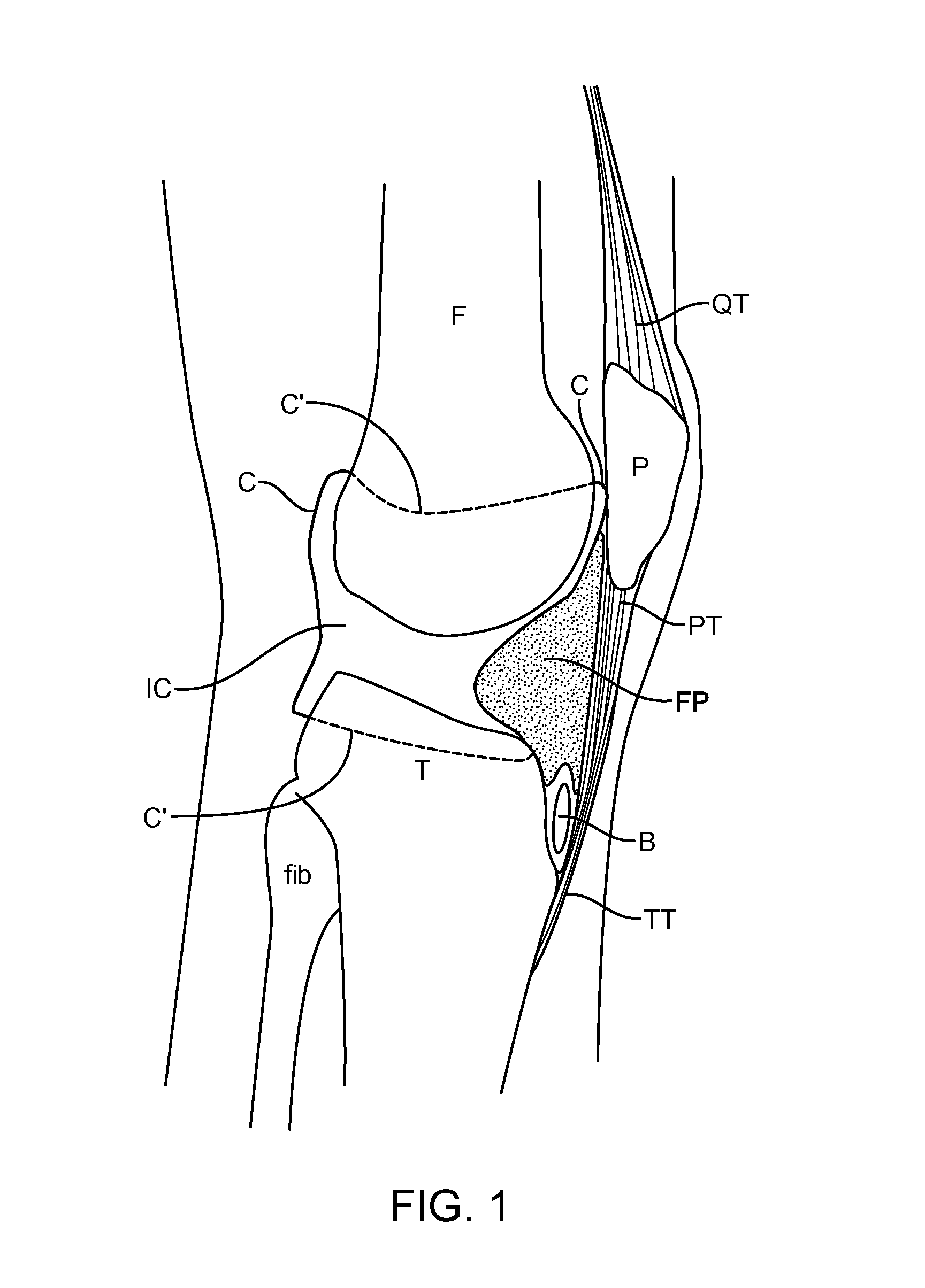 Apparatus and methods for treatment of patellofemoral conditions