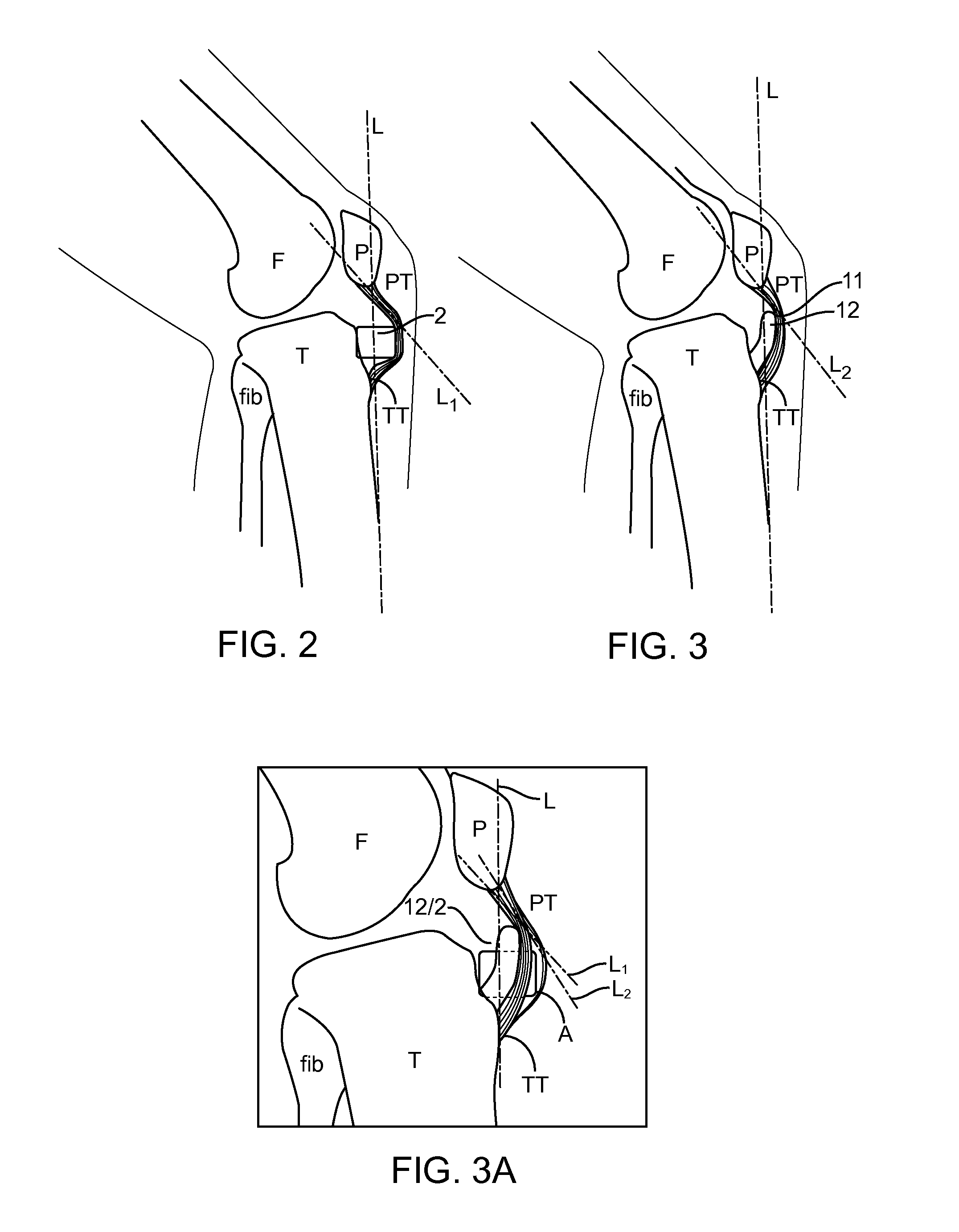 Apparatus and methods for treatment of patellofemoral conditions